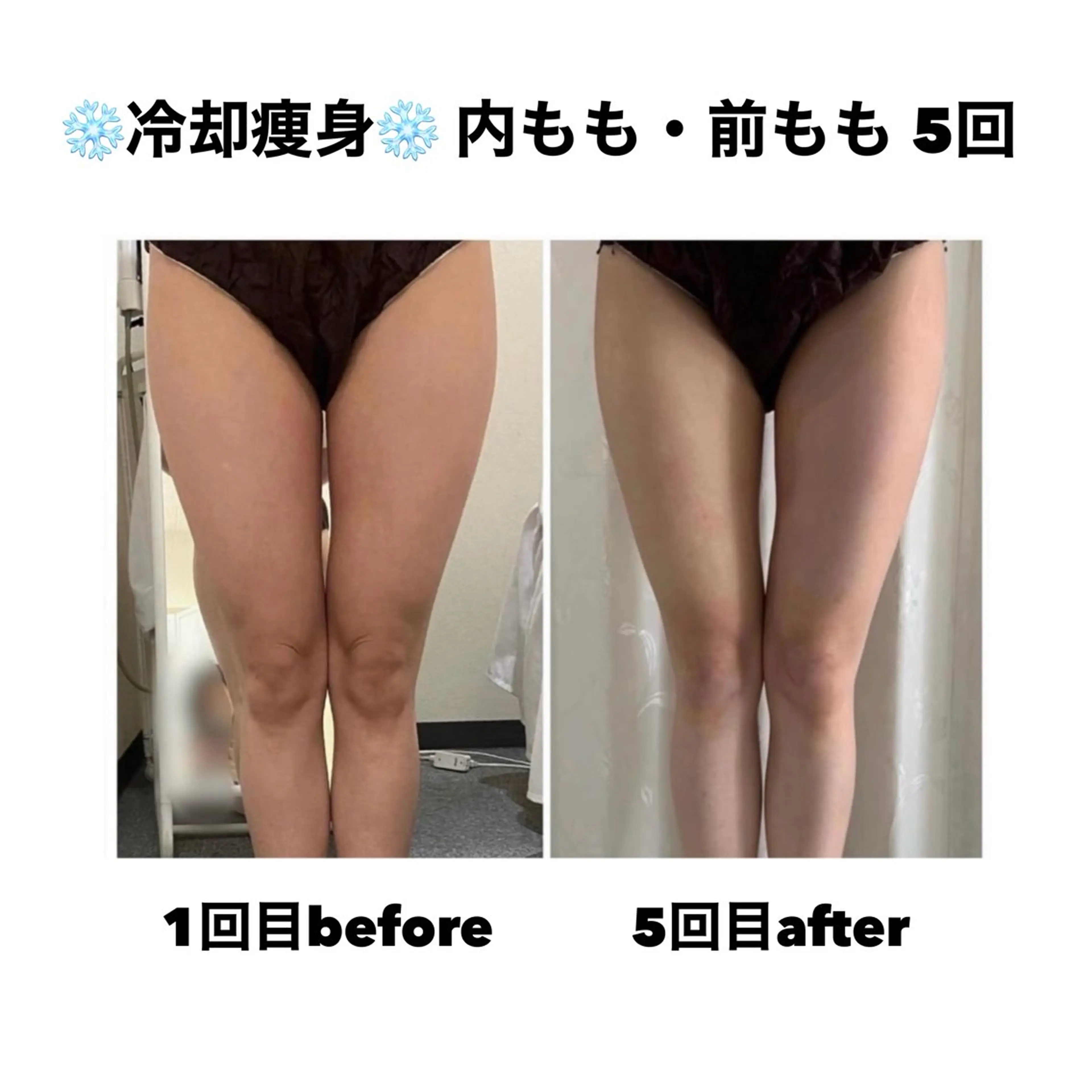 【7月限定‼️3名様】太もも❄️冷却痩身 5回券の写真