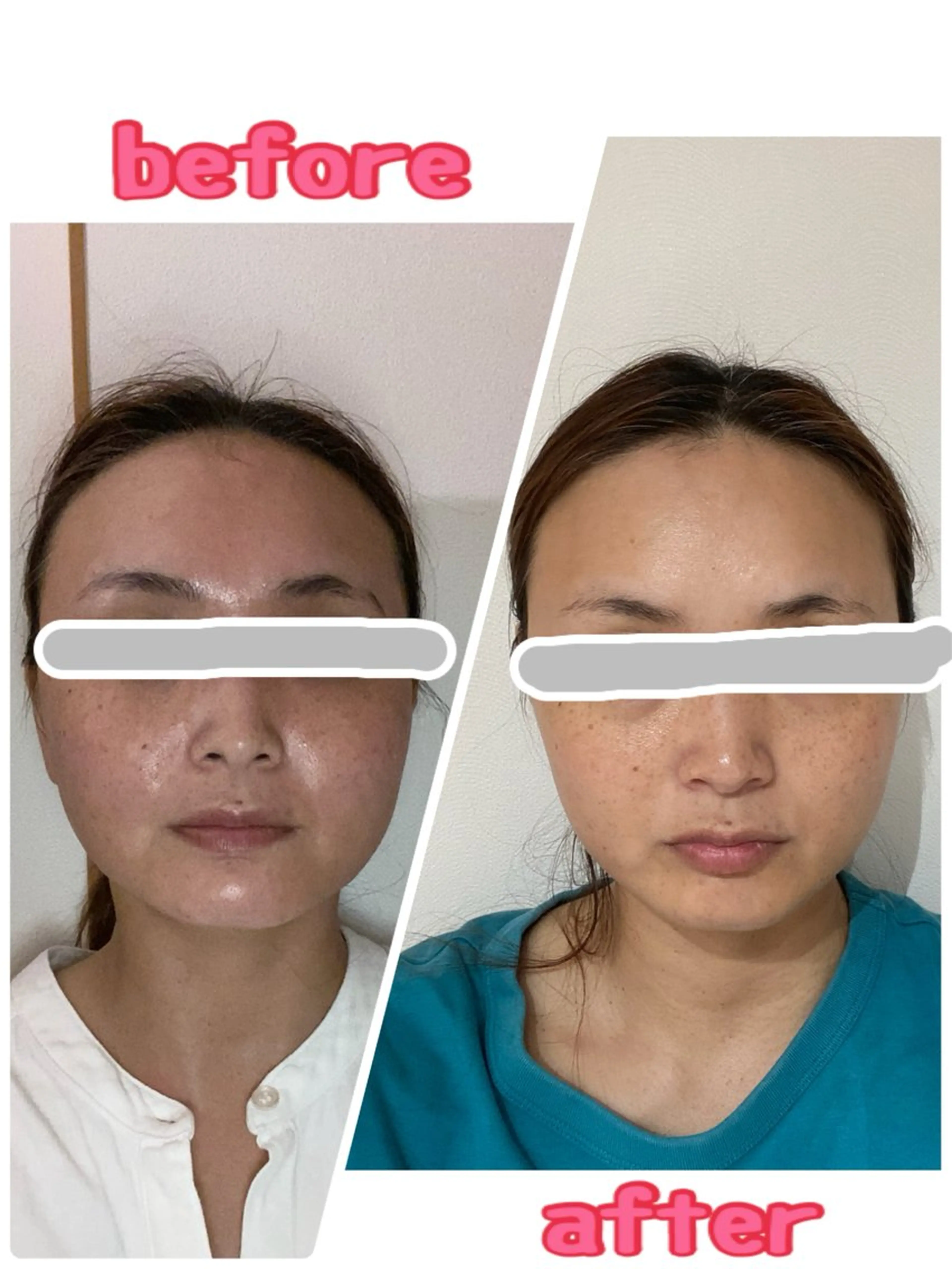 ヒト幹細胞エキスプレミアムトリートメント！！コース料金無し✨キープ制度無し✨1回5,500円の写真