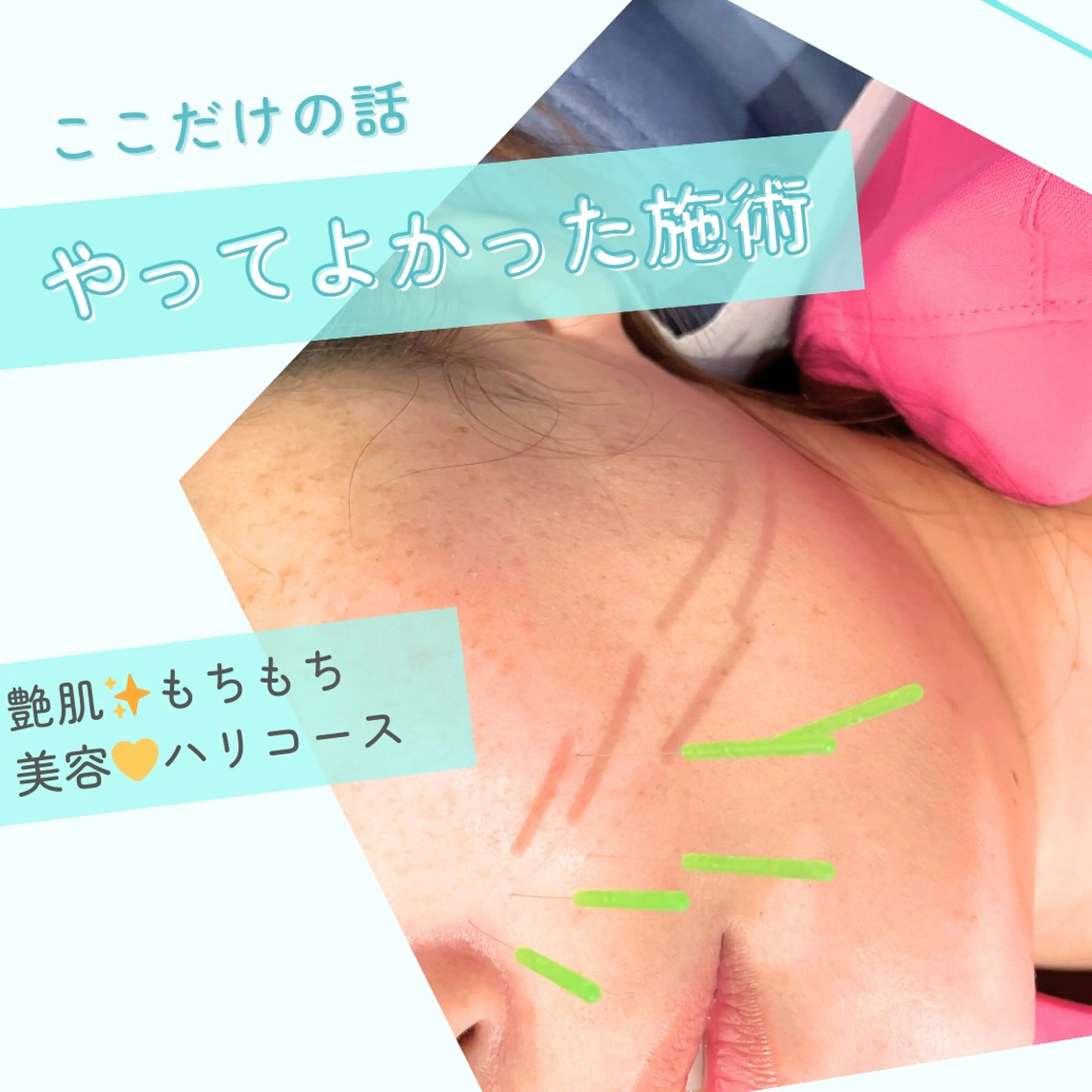 艶肌🌟もちもち美容❣️ハリコースの写真