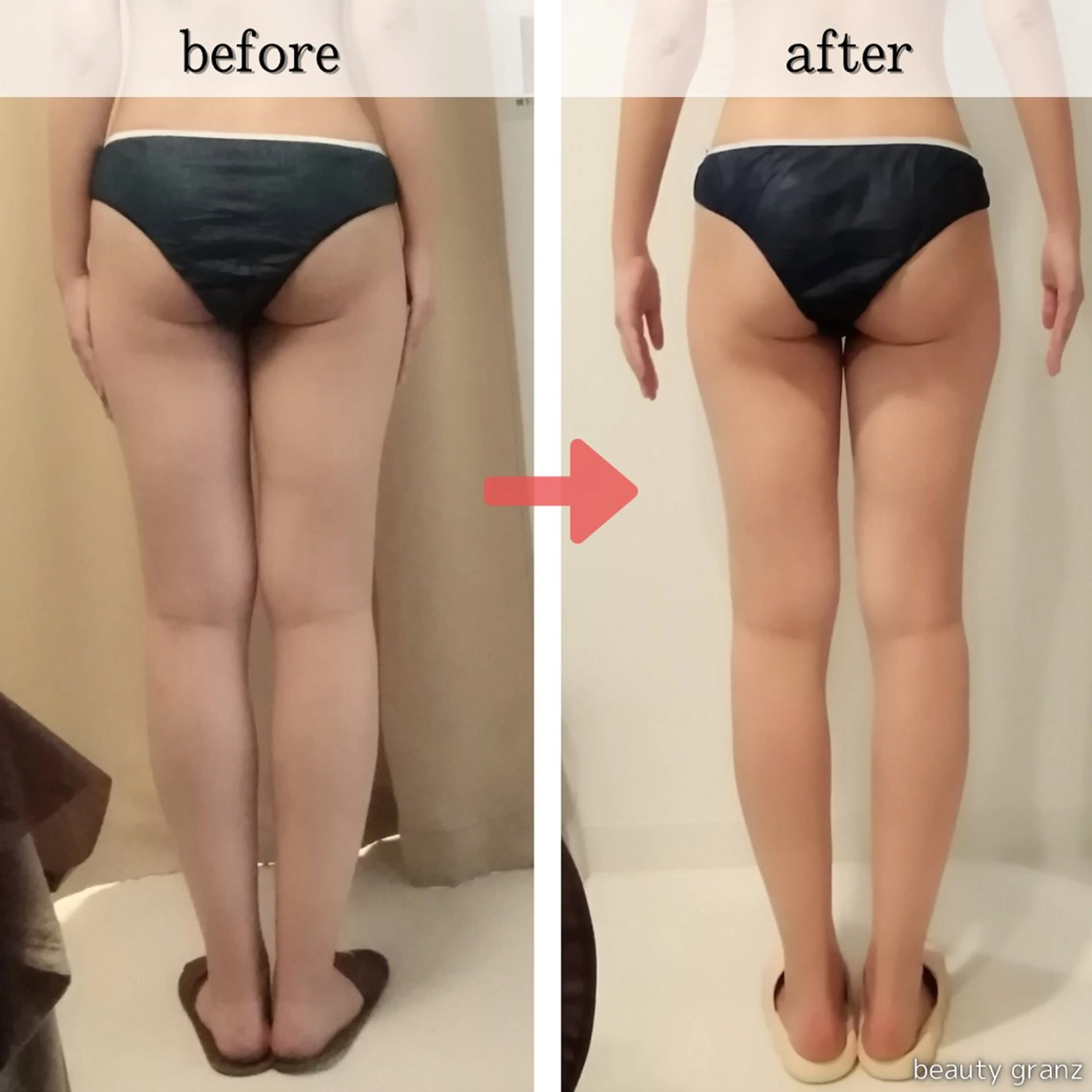 【脚・お尻集中🔥】下半身痩せ70分コース✨凹凸脂肪を徹底ケア！¥18,800→¥6,480の写真