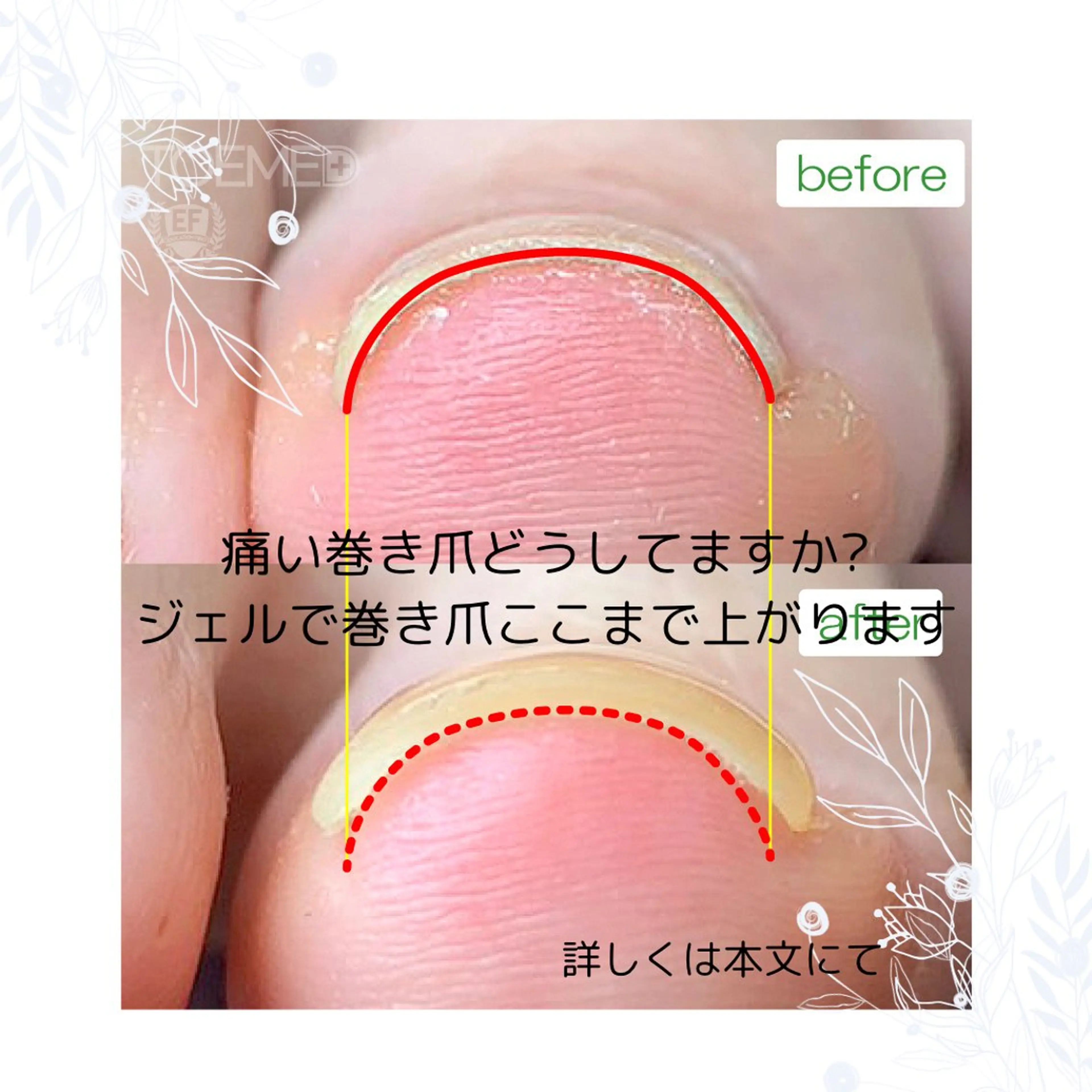 平日限定♪痛い巻き爪ケアーモニター募集♪の写真