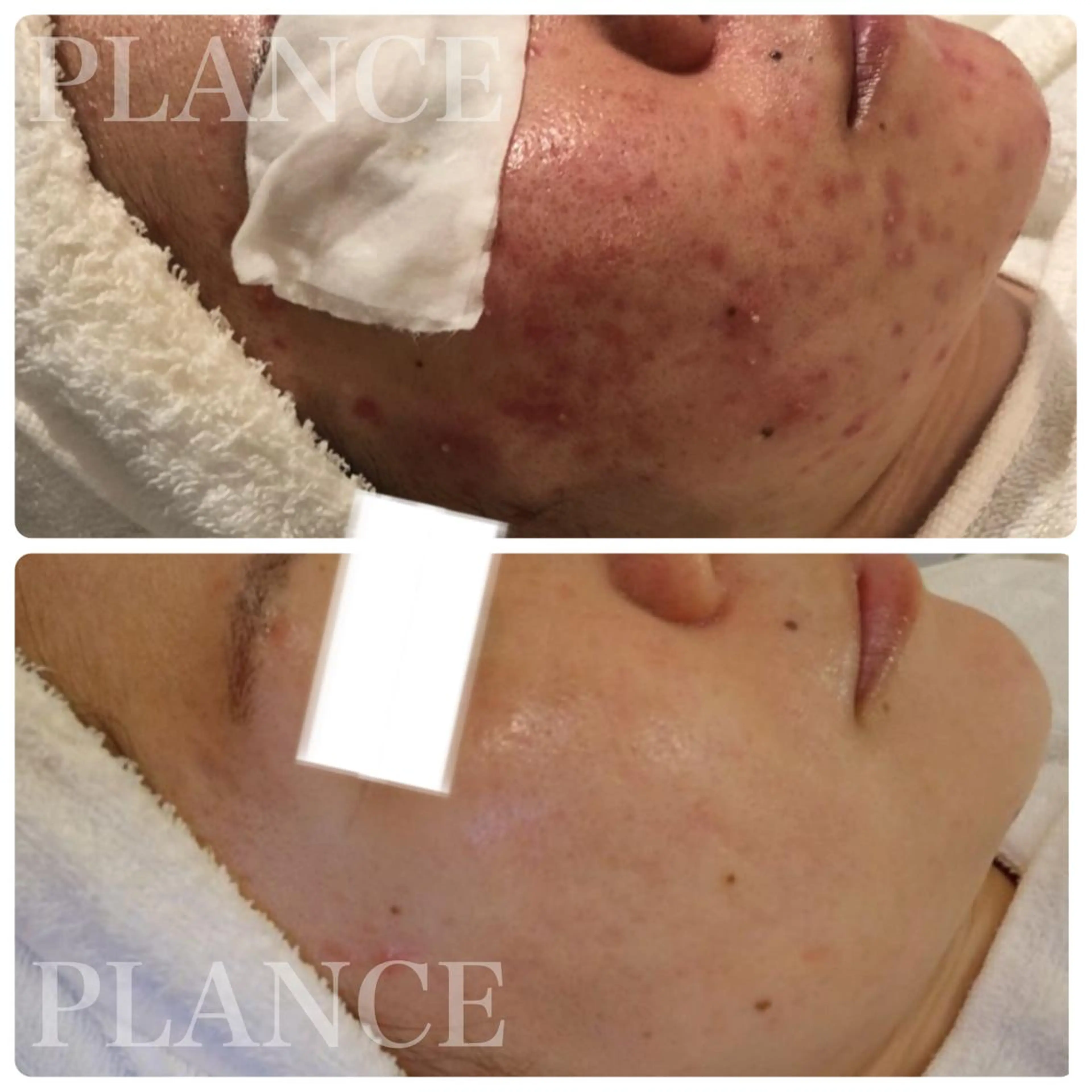 エステ フェイシャル専門 肌質改善/プランスのエステ・リラクイメージ