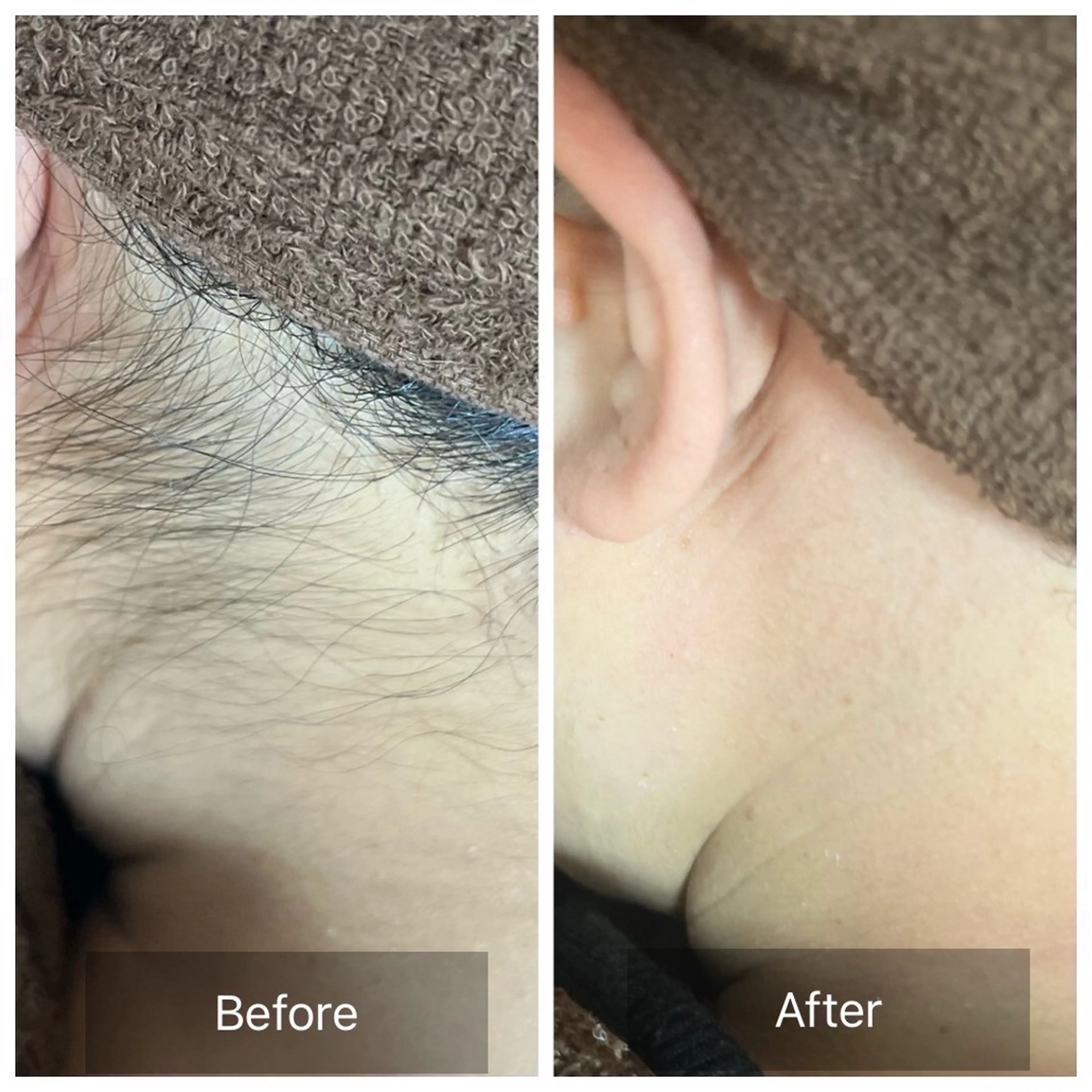 【女性】うなじWax＋SHR光脱毛¥6,400⭐️その日にツルスベうなじへ✨の写真