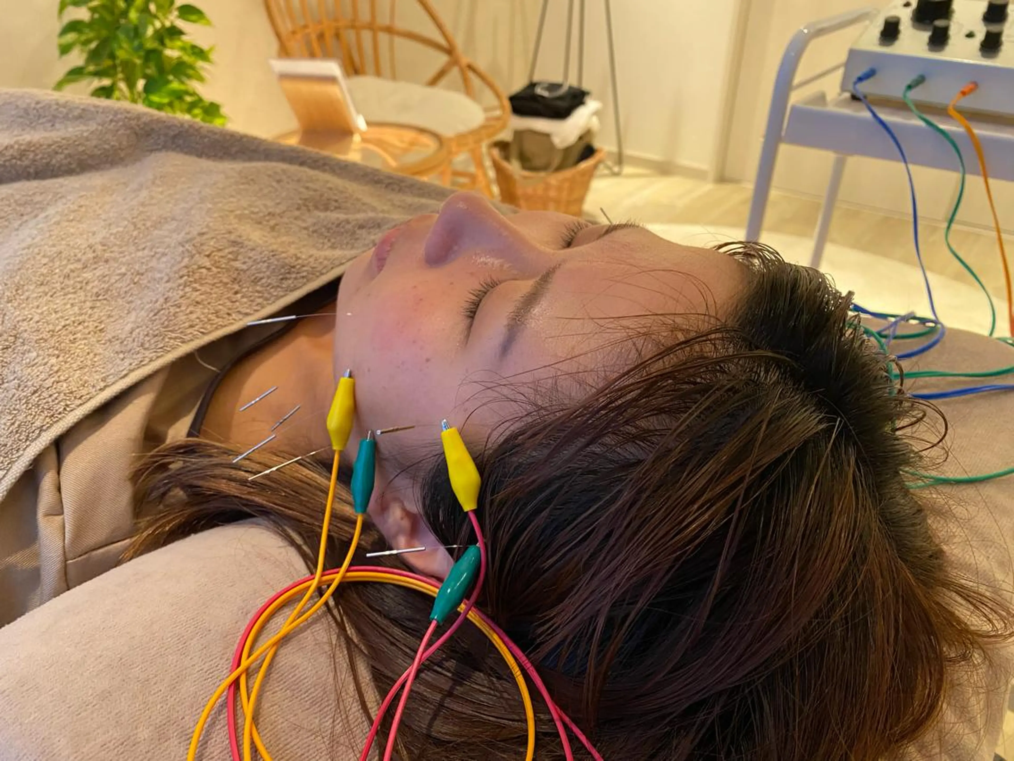 根本から整える美容鍼の写真