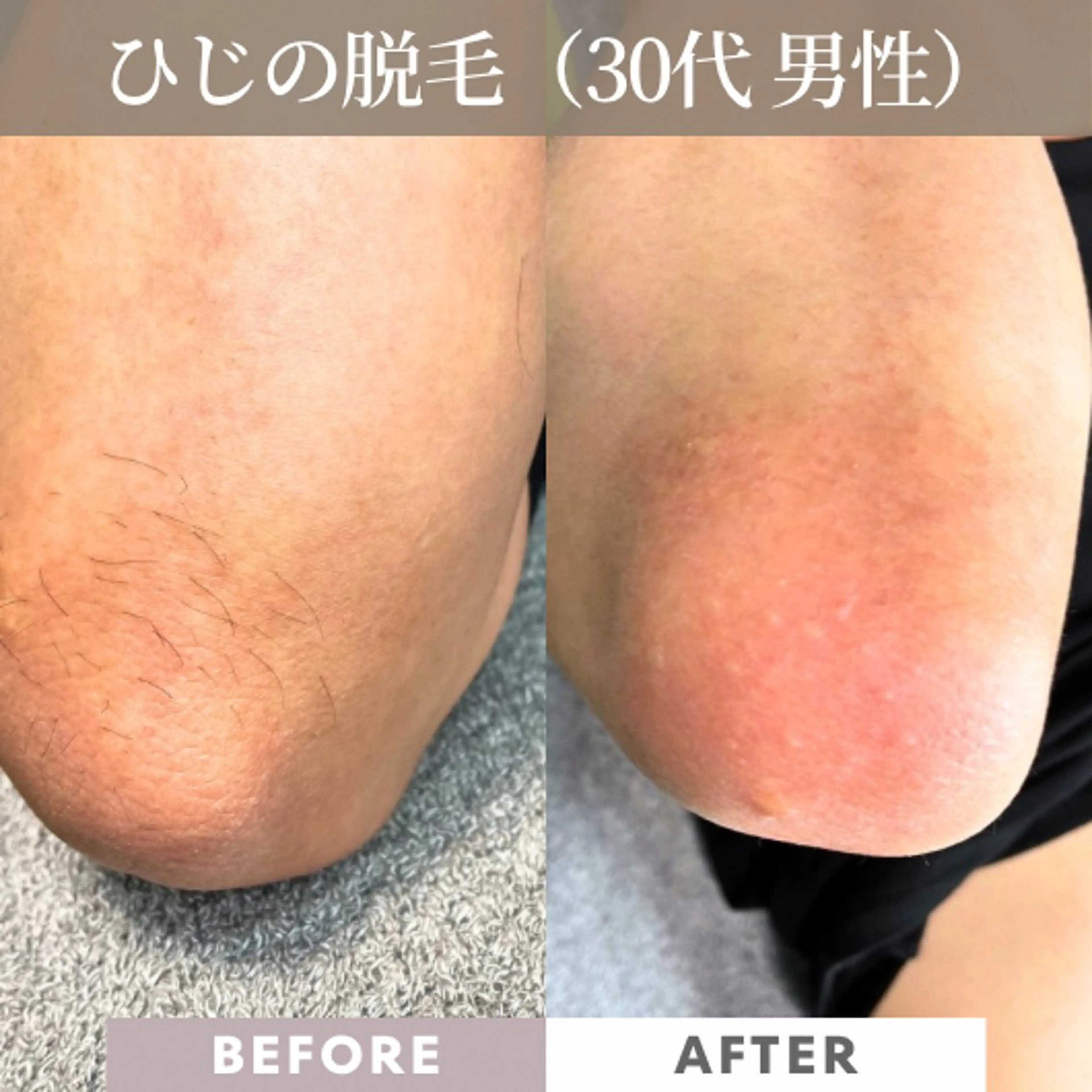 メンズ 美容電気脱毛サロン ReMoveリムーブのエステ・リラクイメージ