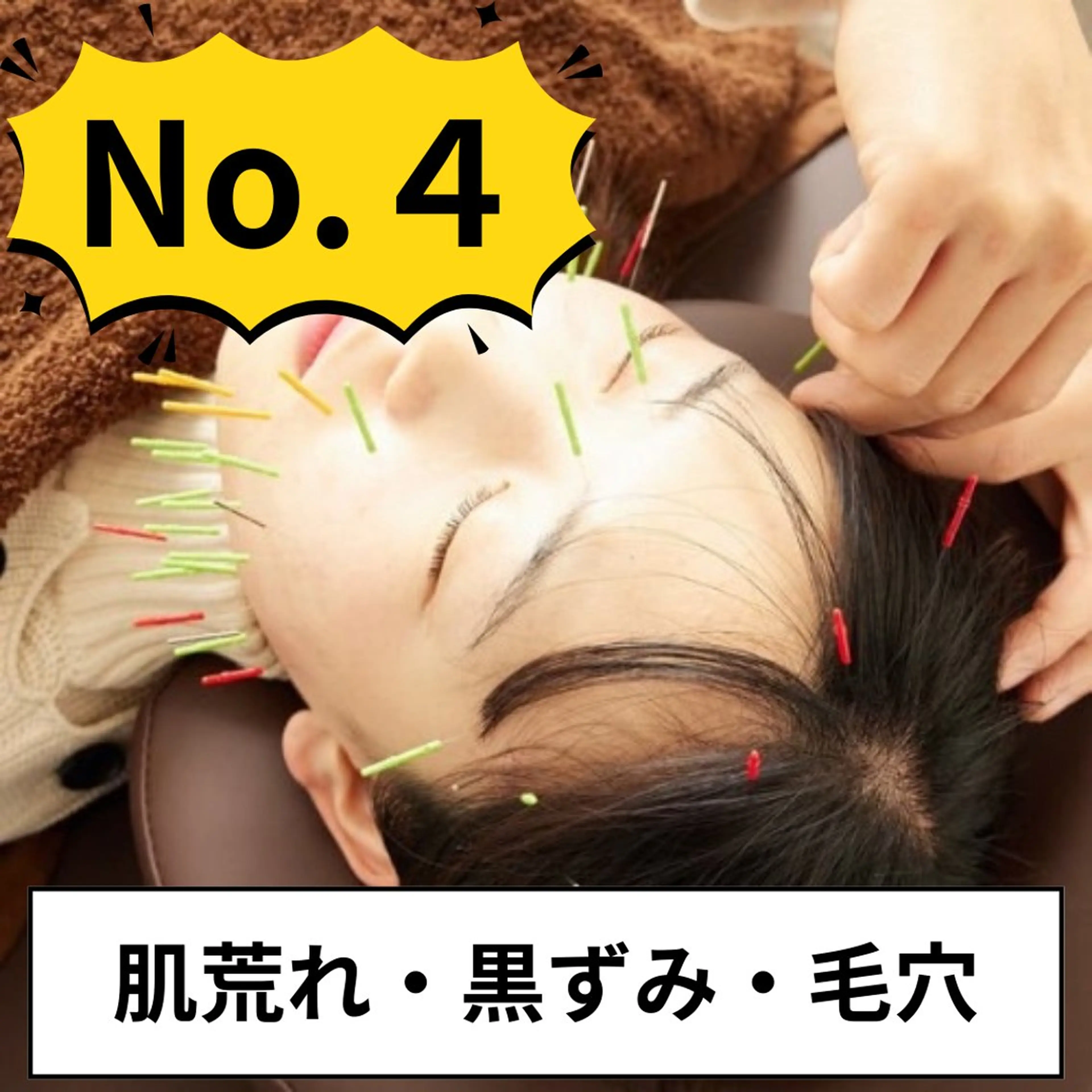 【12月限定☆ツヤ肌】美容鍼+ハーブピーリング＋毛穴洗浄 ¥16,000→¥5,980の写真