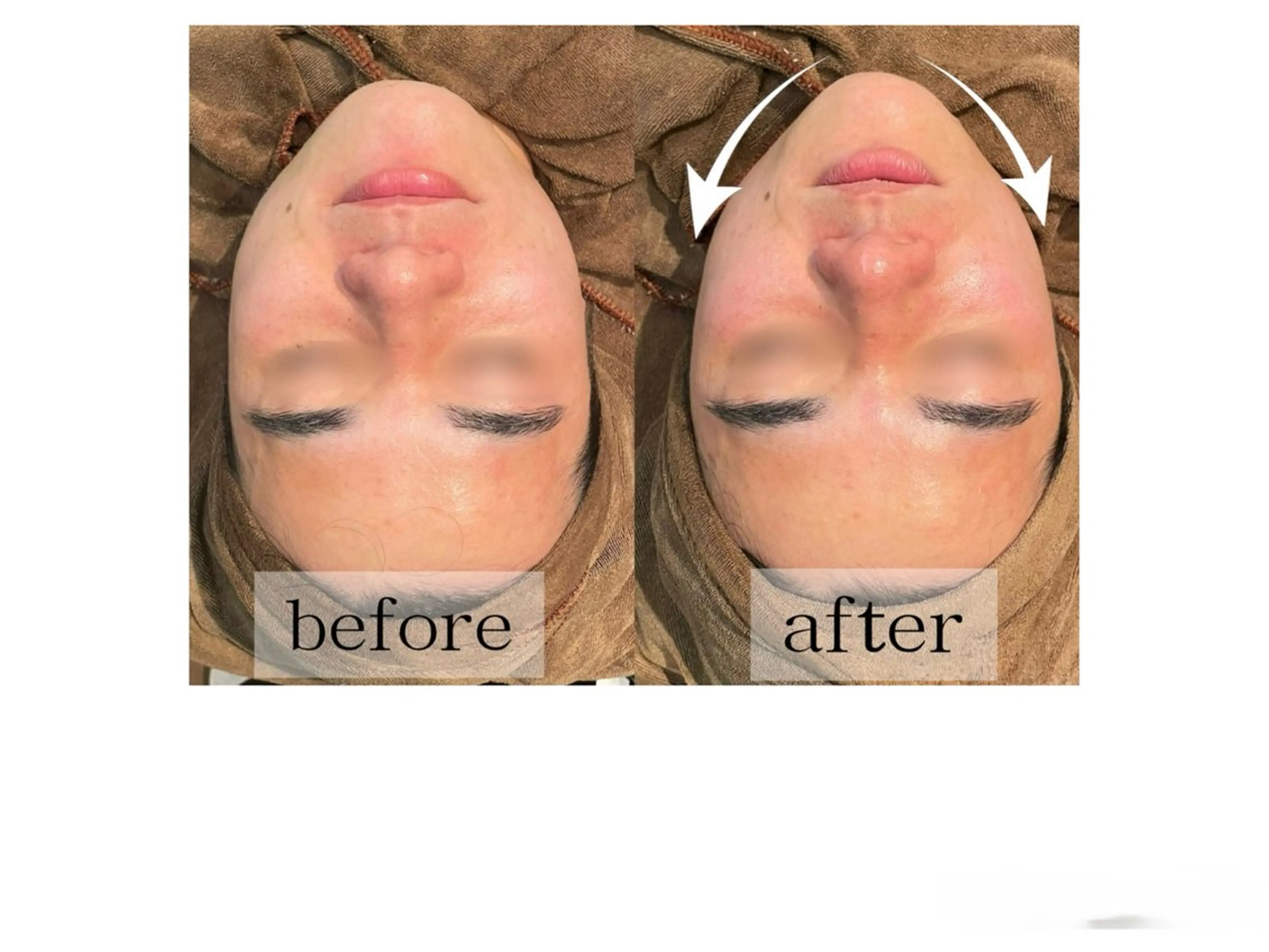 【毛穴/美肌ケア】ハイドラ毛穴洗浄×イオン導入×光フォトの写真