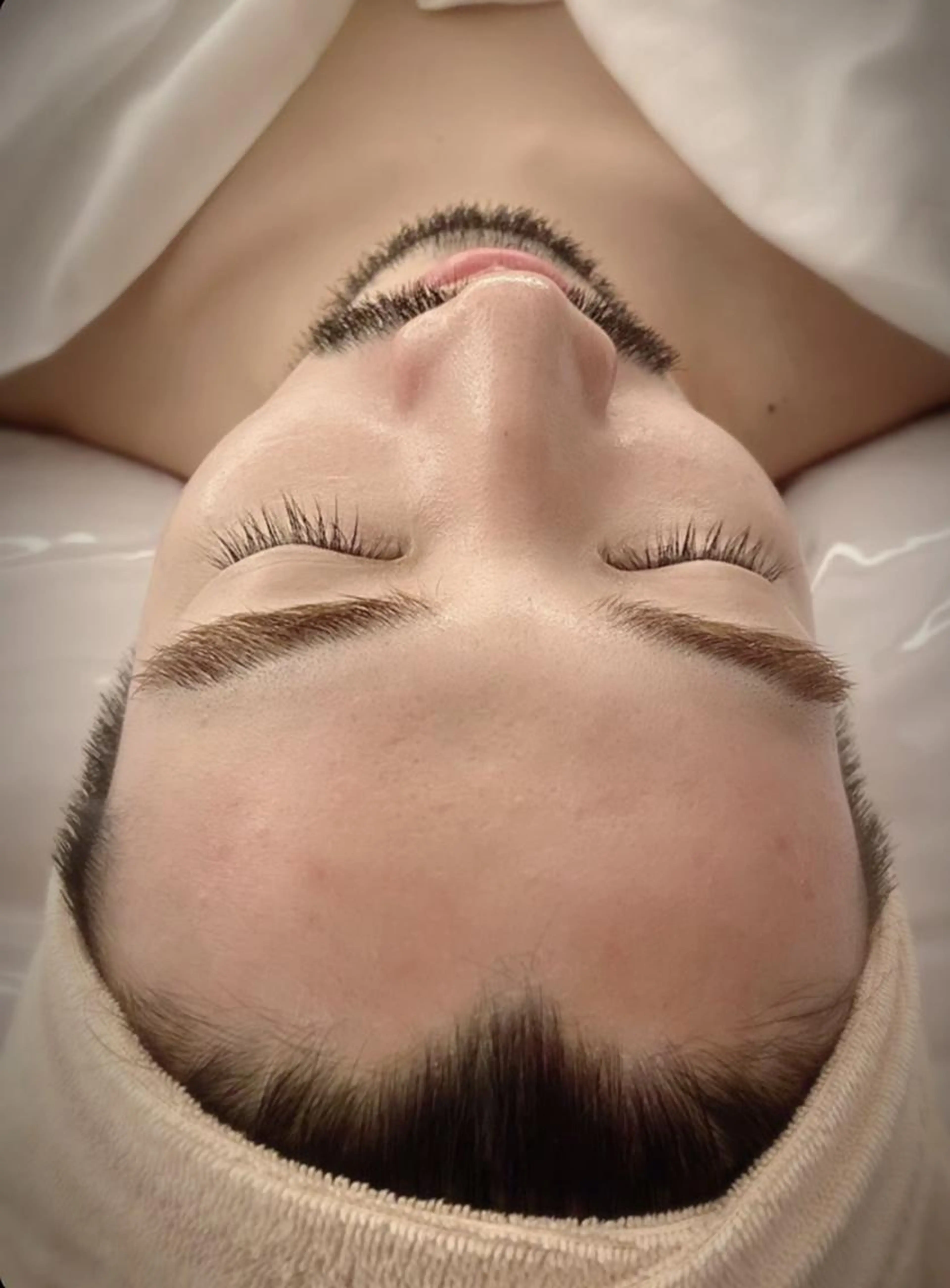 【次世代ハーブピーリング】VOSサロンケア　メンズニキビケア　毛穴　肌質改善 ￥11000の写真