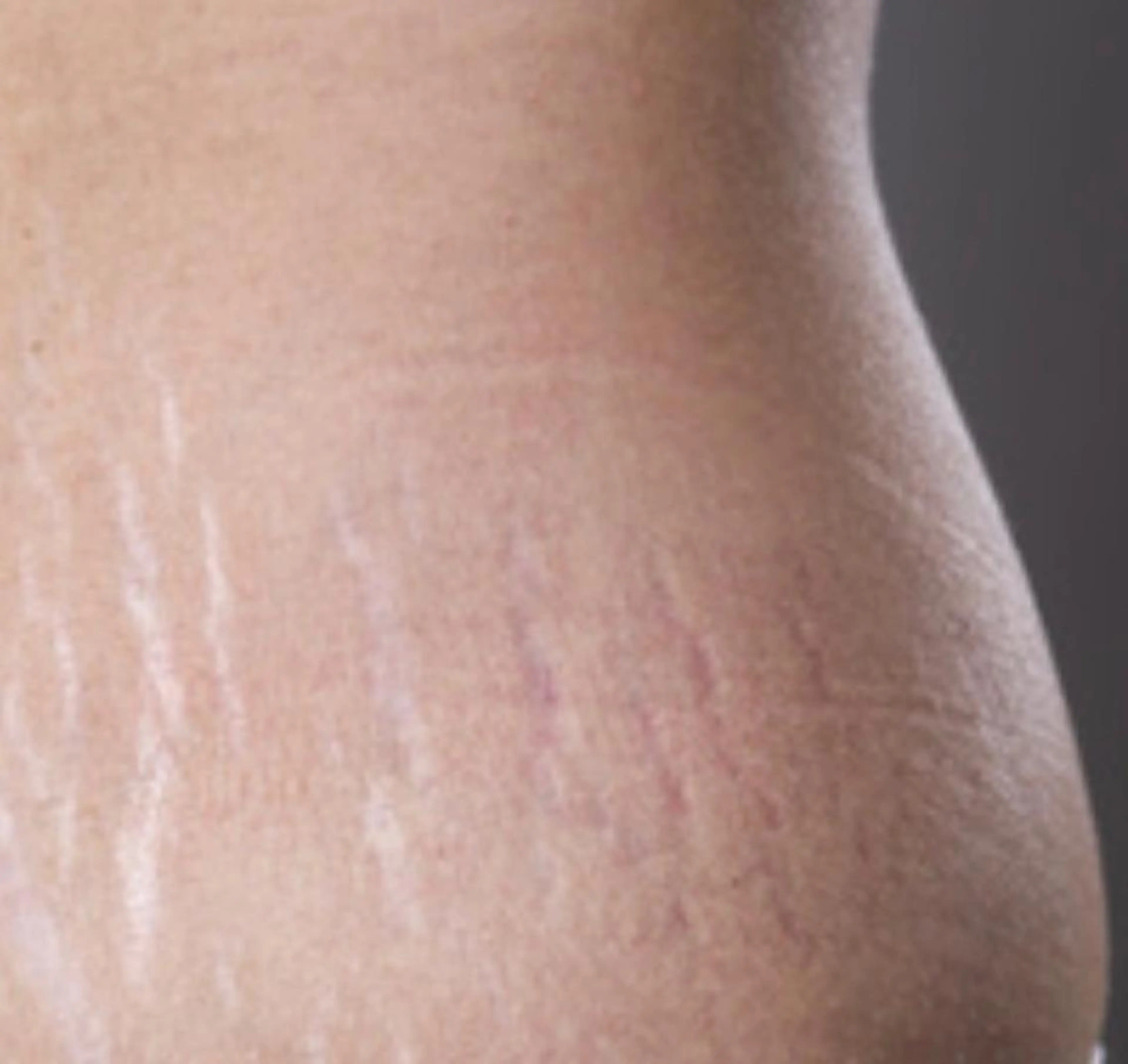 🉐くびれ特化【ウエスト集中＆妊娠線ケアプラン】★セルフ★ボディ12000s➕高周波9000sの最強組合せ⭐️の写真