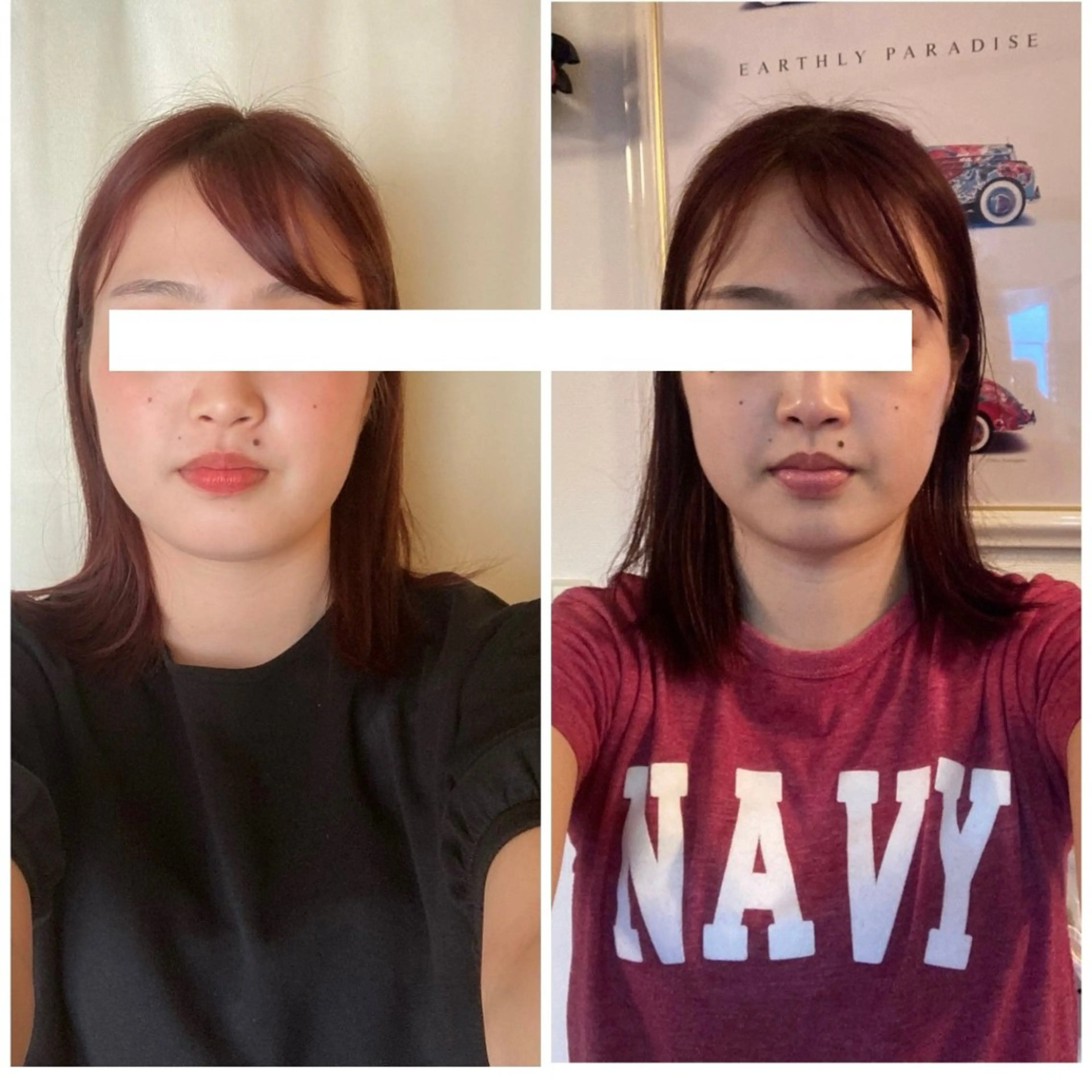 魔法の小顔矯正【エンドリングフェイシャル®︎】スペシャルコースの写真