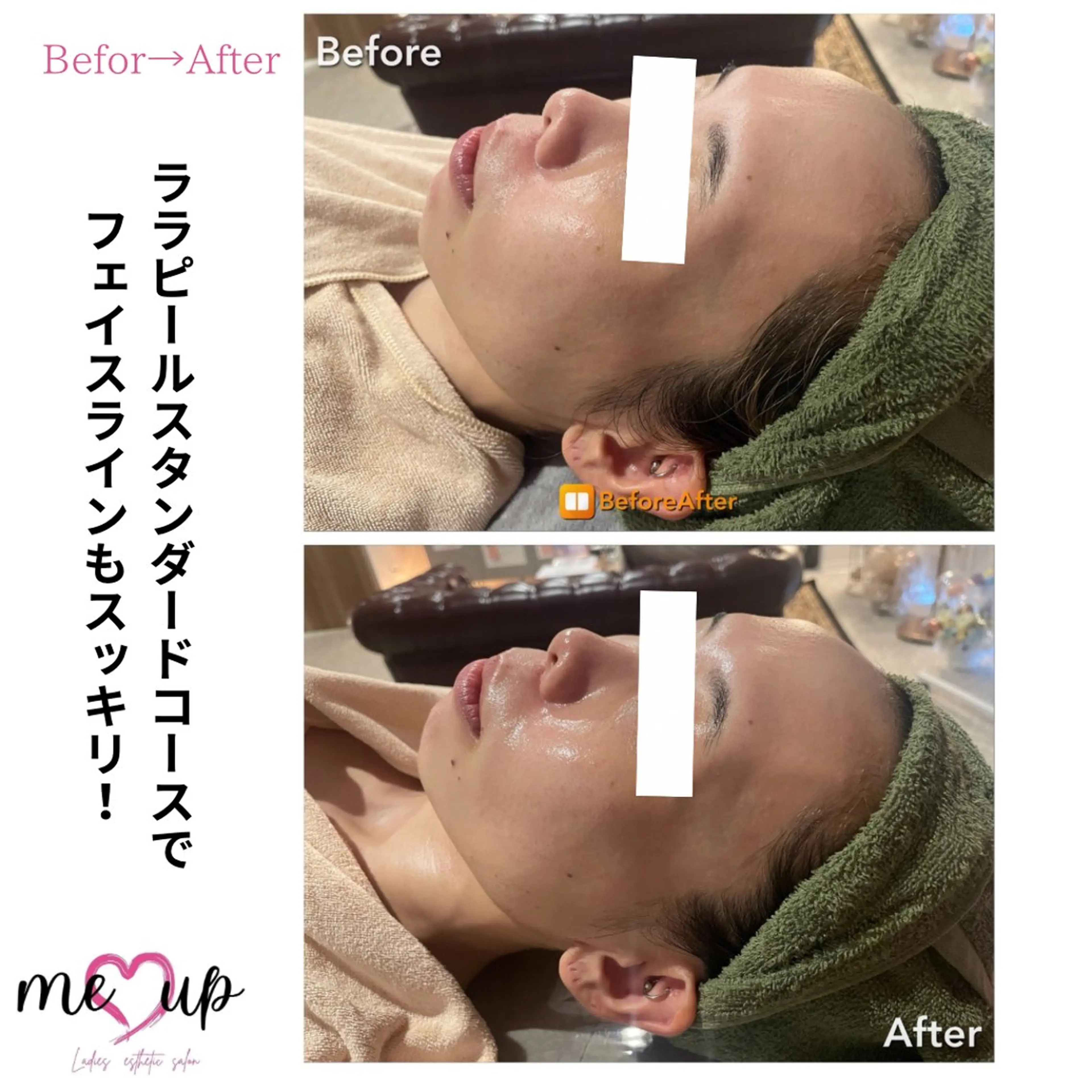 エステ Meupニキビ専門店 背中/ハーブ/肌管理のその他イメージ