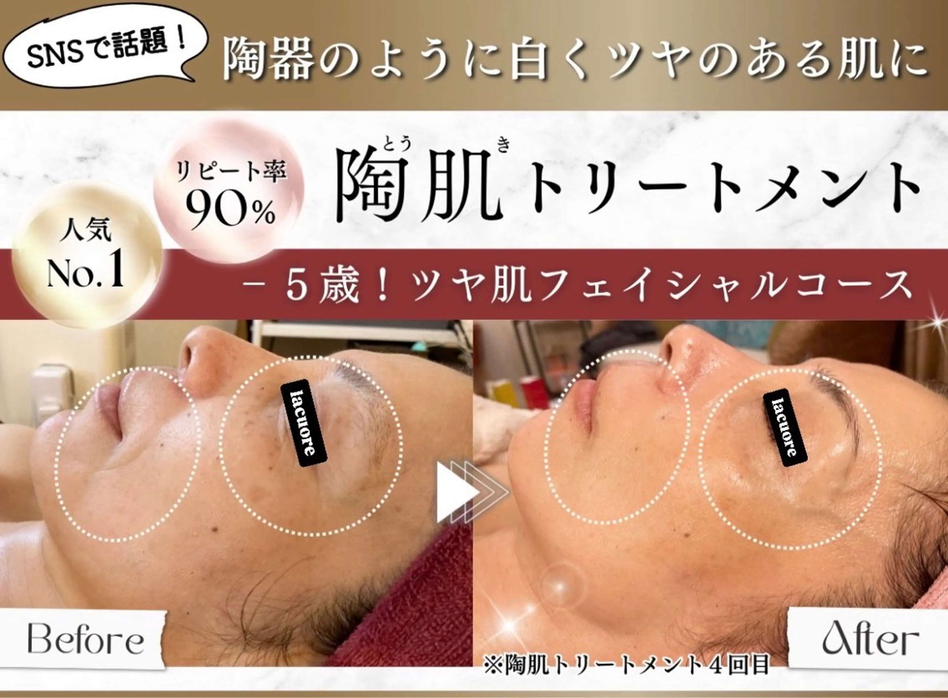 【人気No.1】ハーブピーリング 陶肌(とうき)トリートメント🌹ツヤ肌リフトアップコース 日進 長久手の写真