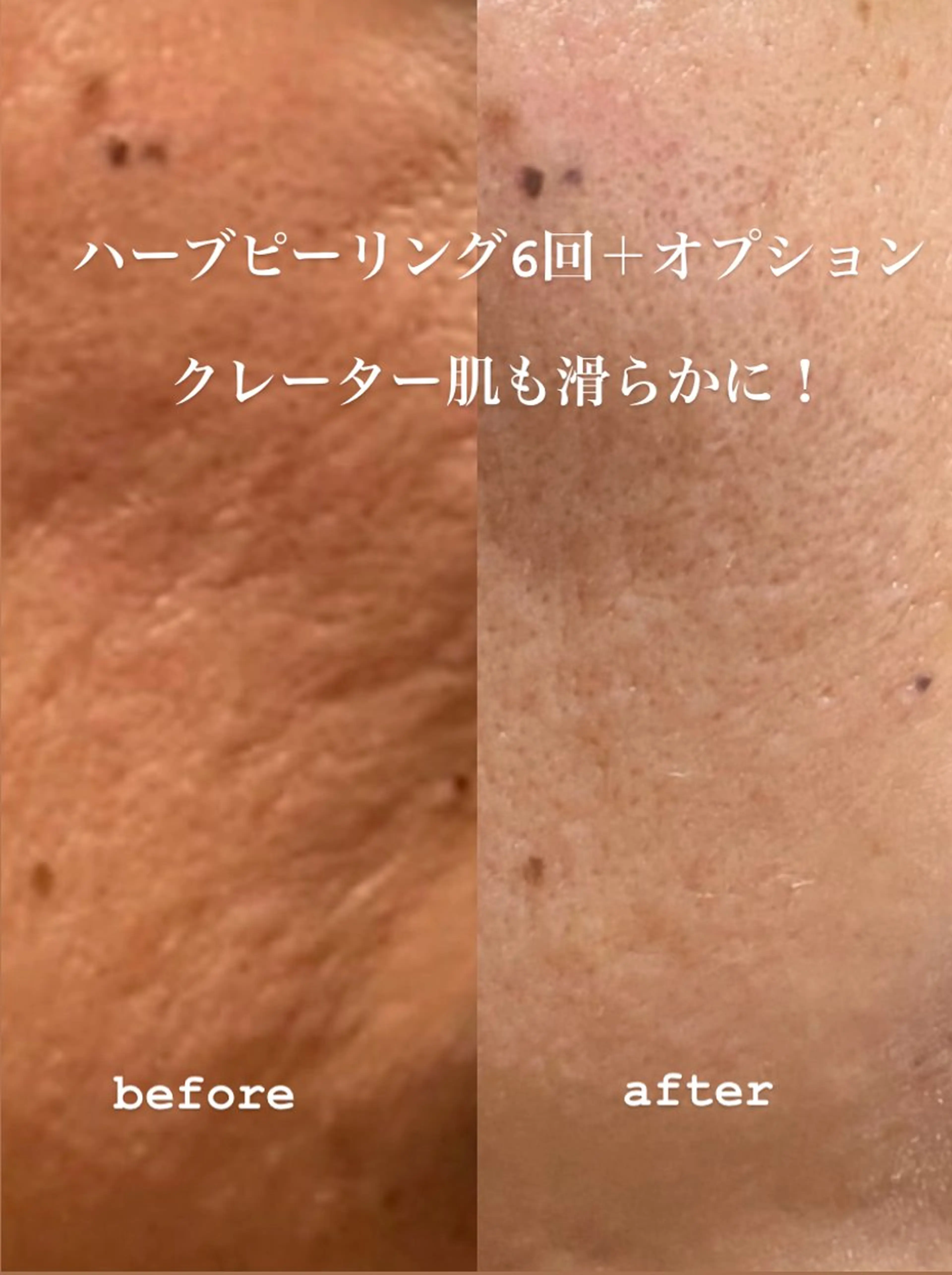 メンズ クレアス勝どき・肌質改善専門店【CREAS Beauty Salon】所属・クレアス勝どき【毛穴 ハーブピーリング専門のエステ・リラクイメージ