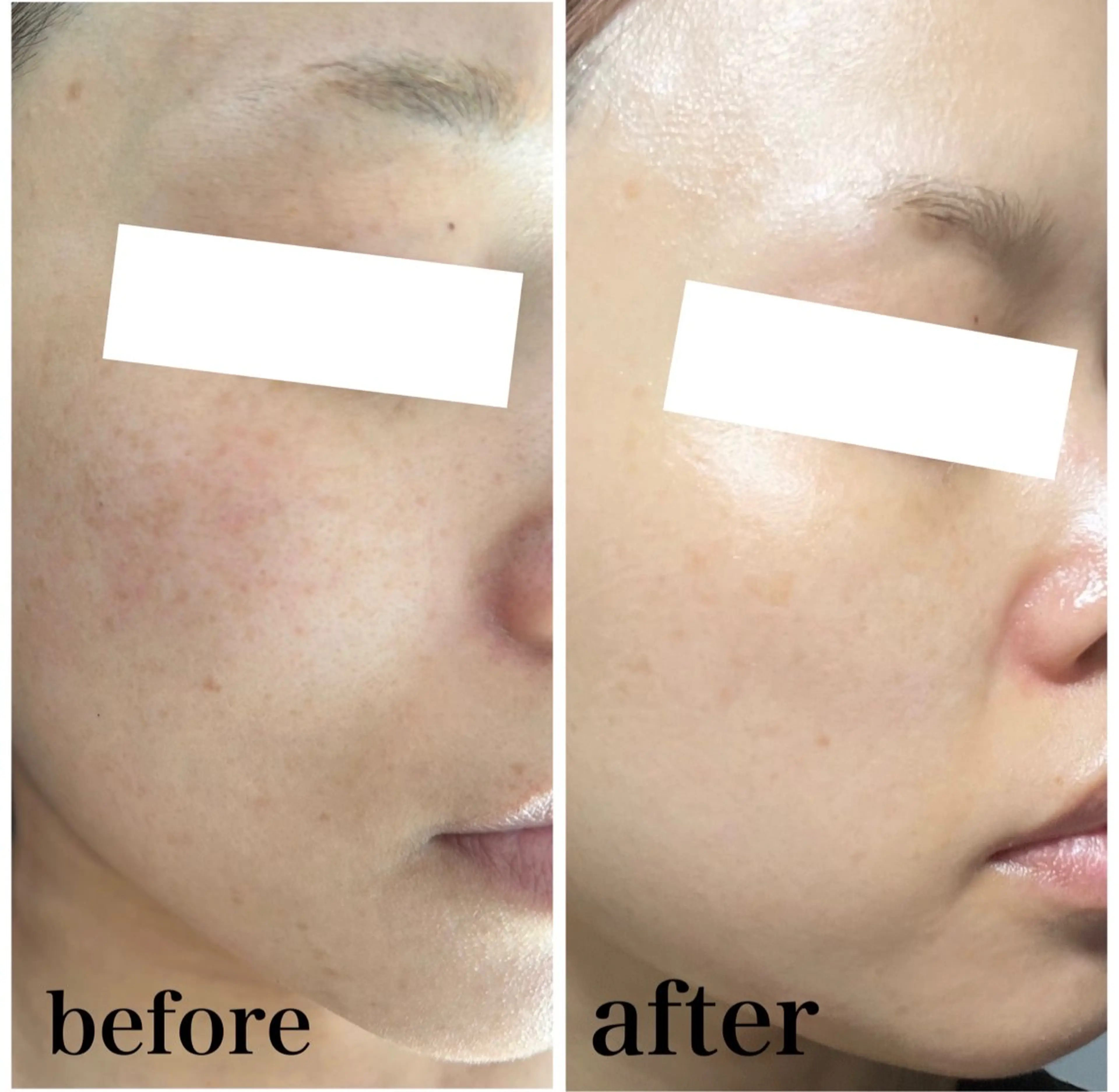 ヒト幹細胞配合ハーブピーリング🌿‬の写真