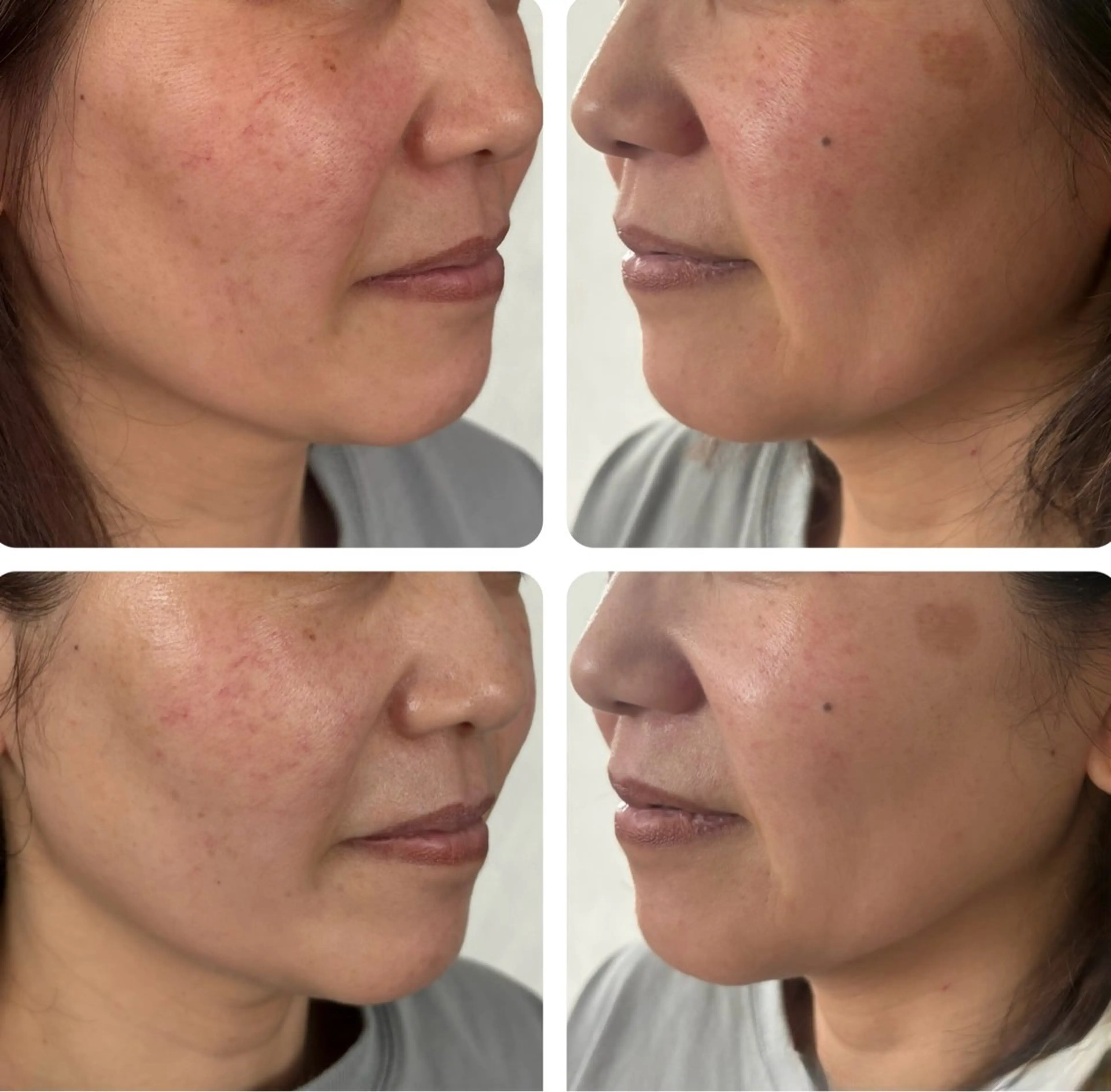 小顔矯正⭐︎【お顔の内側と外側から顎を調整する大人気オプションメニュー】の写真