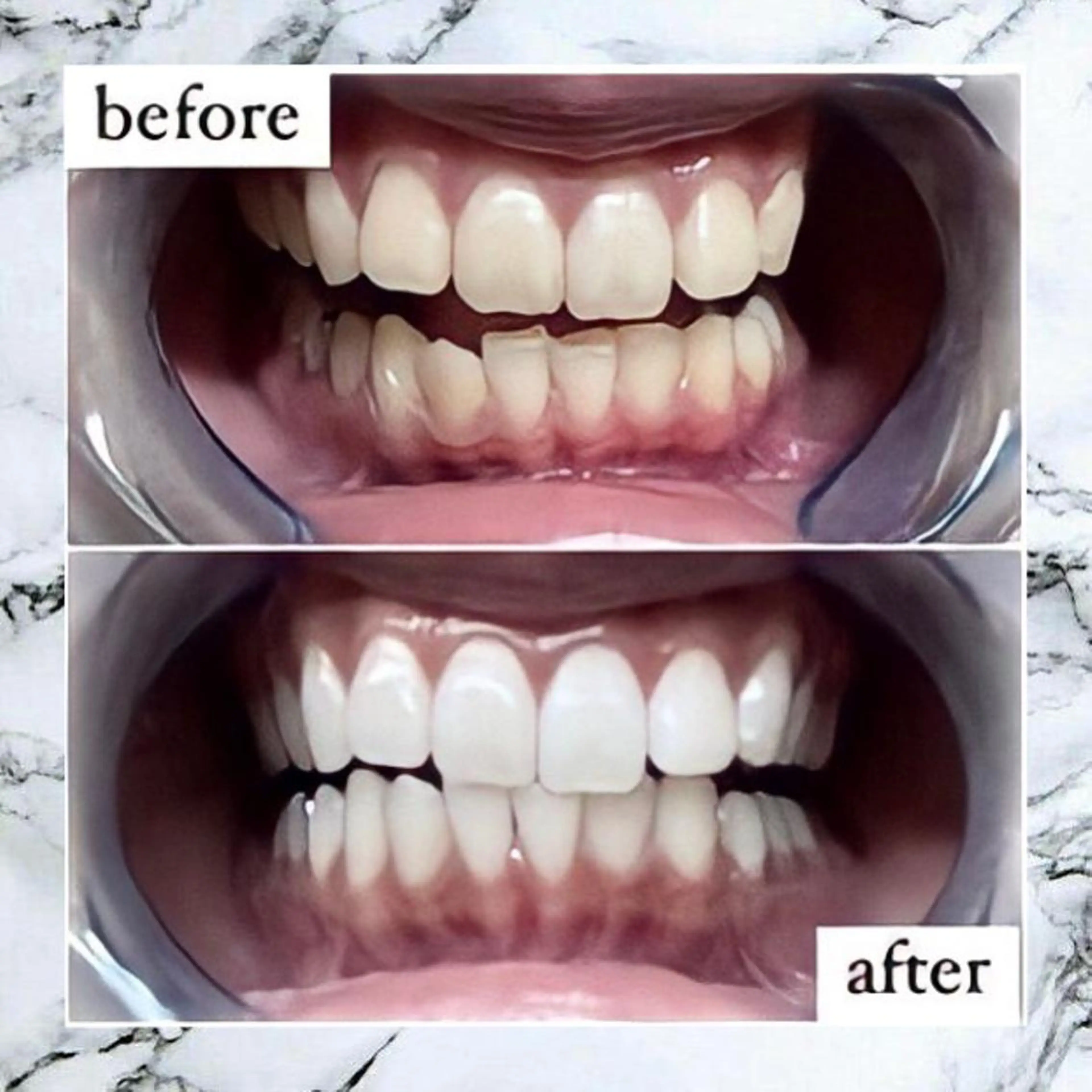 👭ご紹介の方限定👭セルフホワイトニング初回体験10分×3回　¥1,980の写真