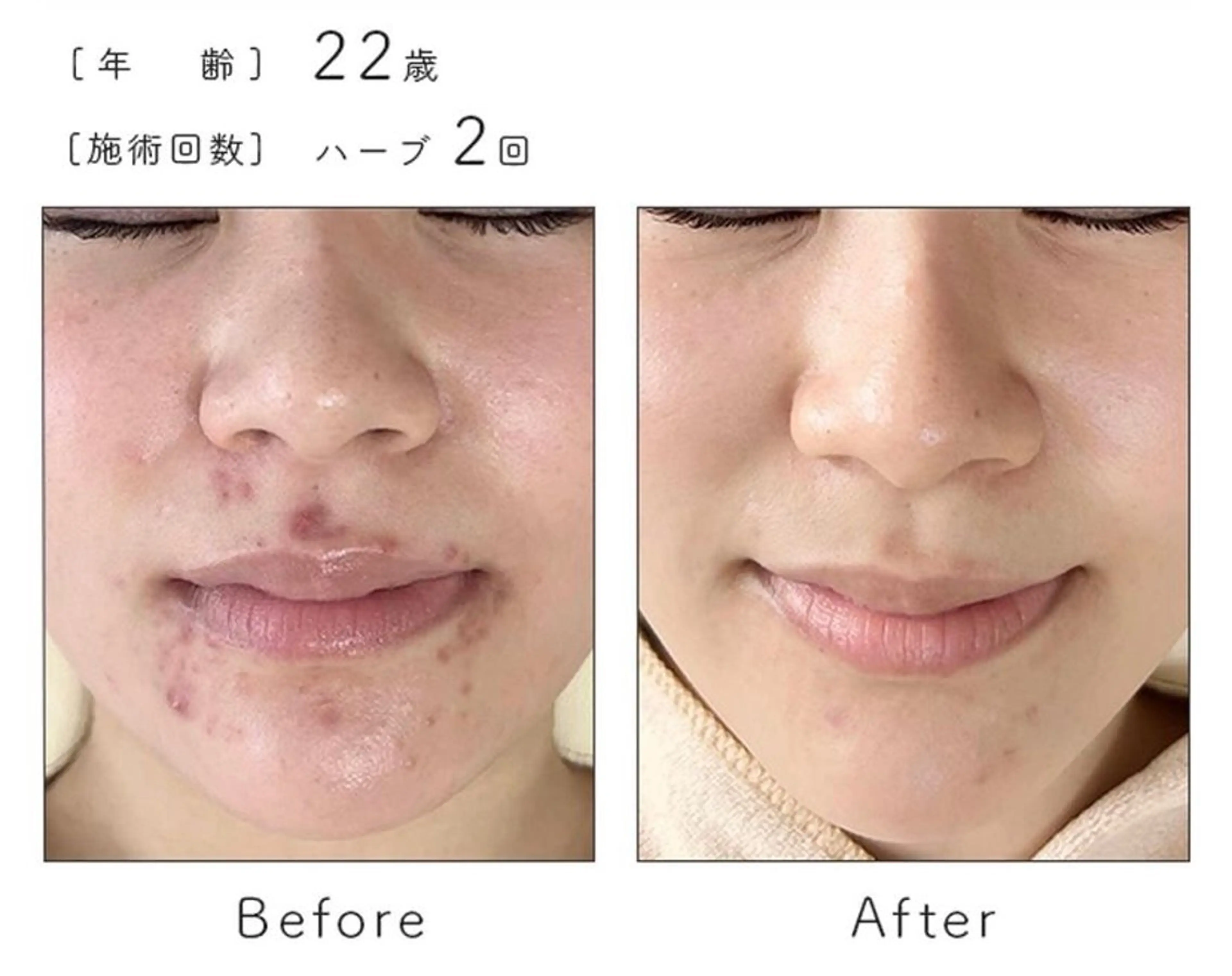 エステ ハーブピーリング専門 BIOEL横浜のエステ・リラクイメージ