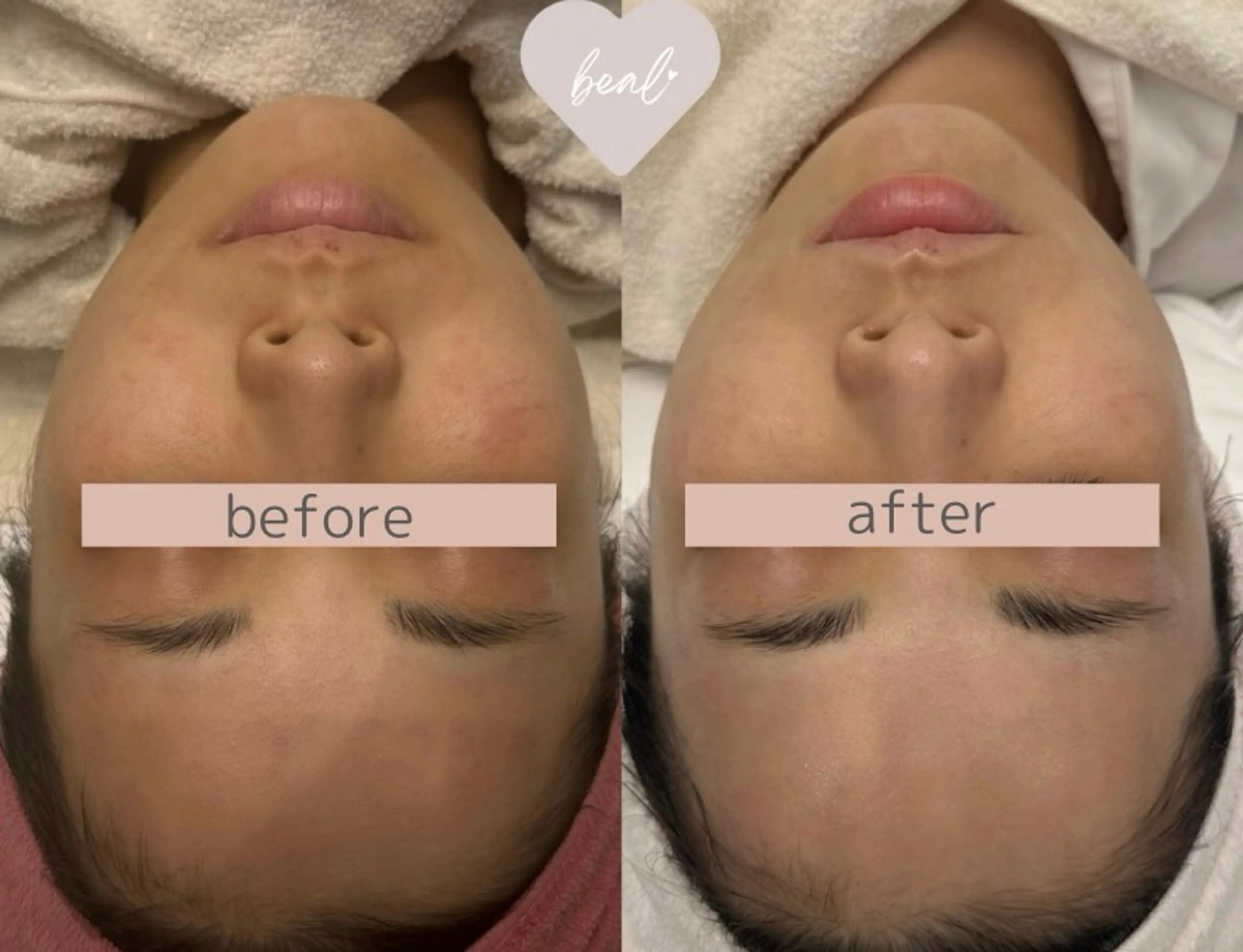 【毛穴・くすみリセット】透明感アップフェイシャル¥22000→の写真