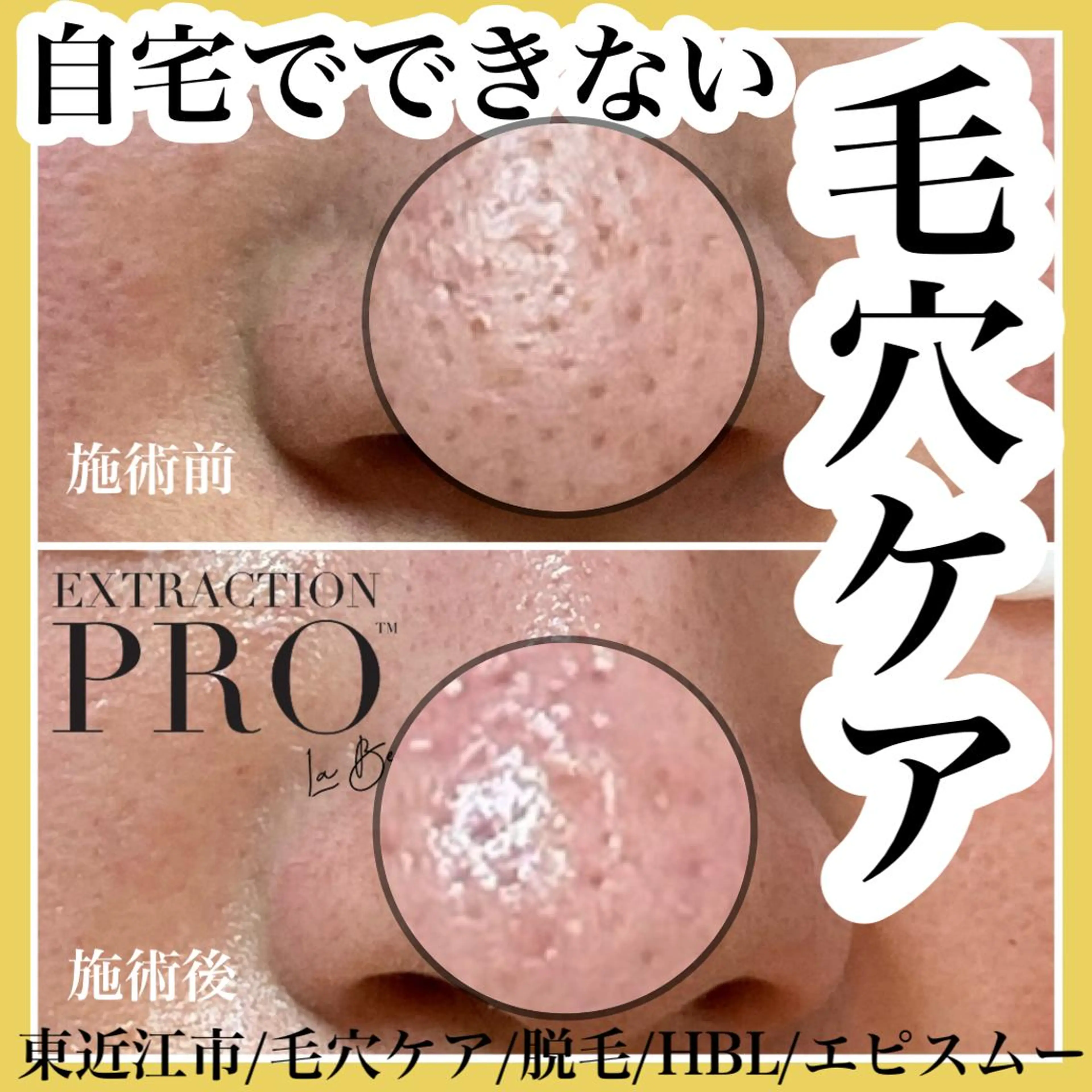 epismoo 脱毛/HBL/毛穴の眉毛・アイブロウイメージ