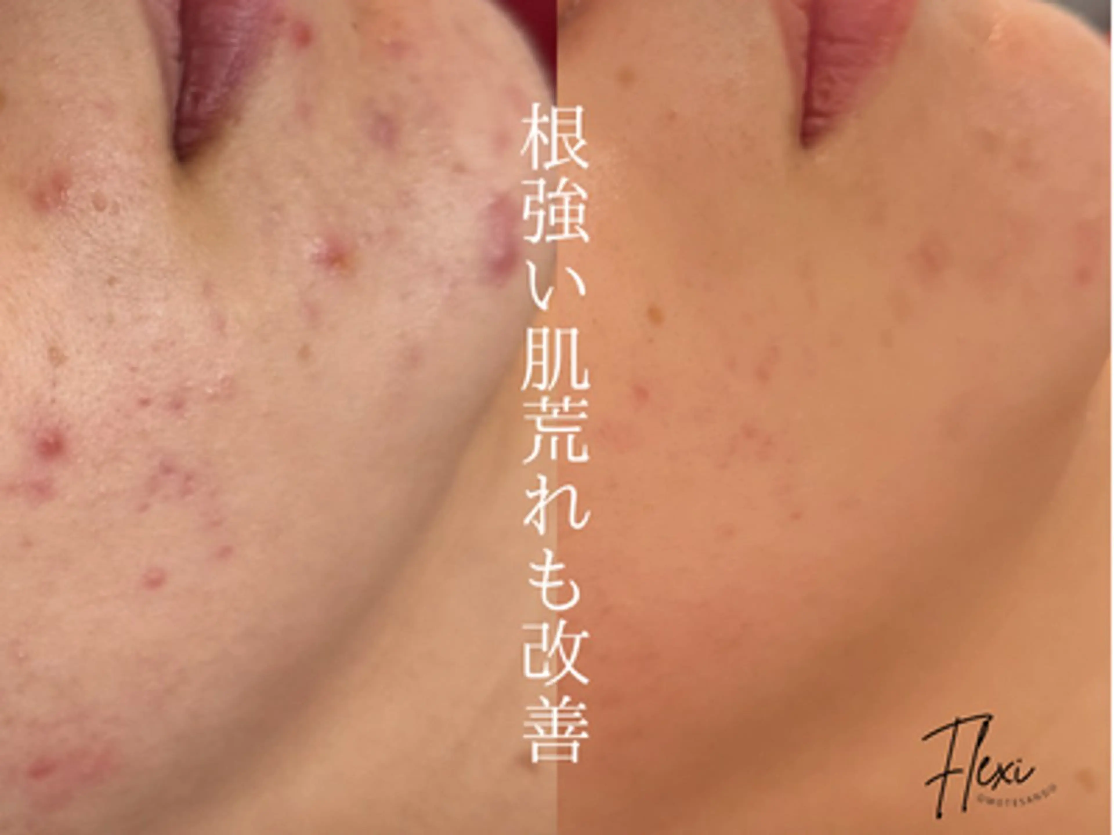 Flexi 表参道所属・🌟ニキビ・毛穴ケア 🌿Flexi表参道のエステ・リラクイメージ