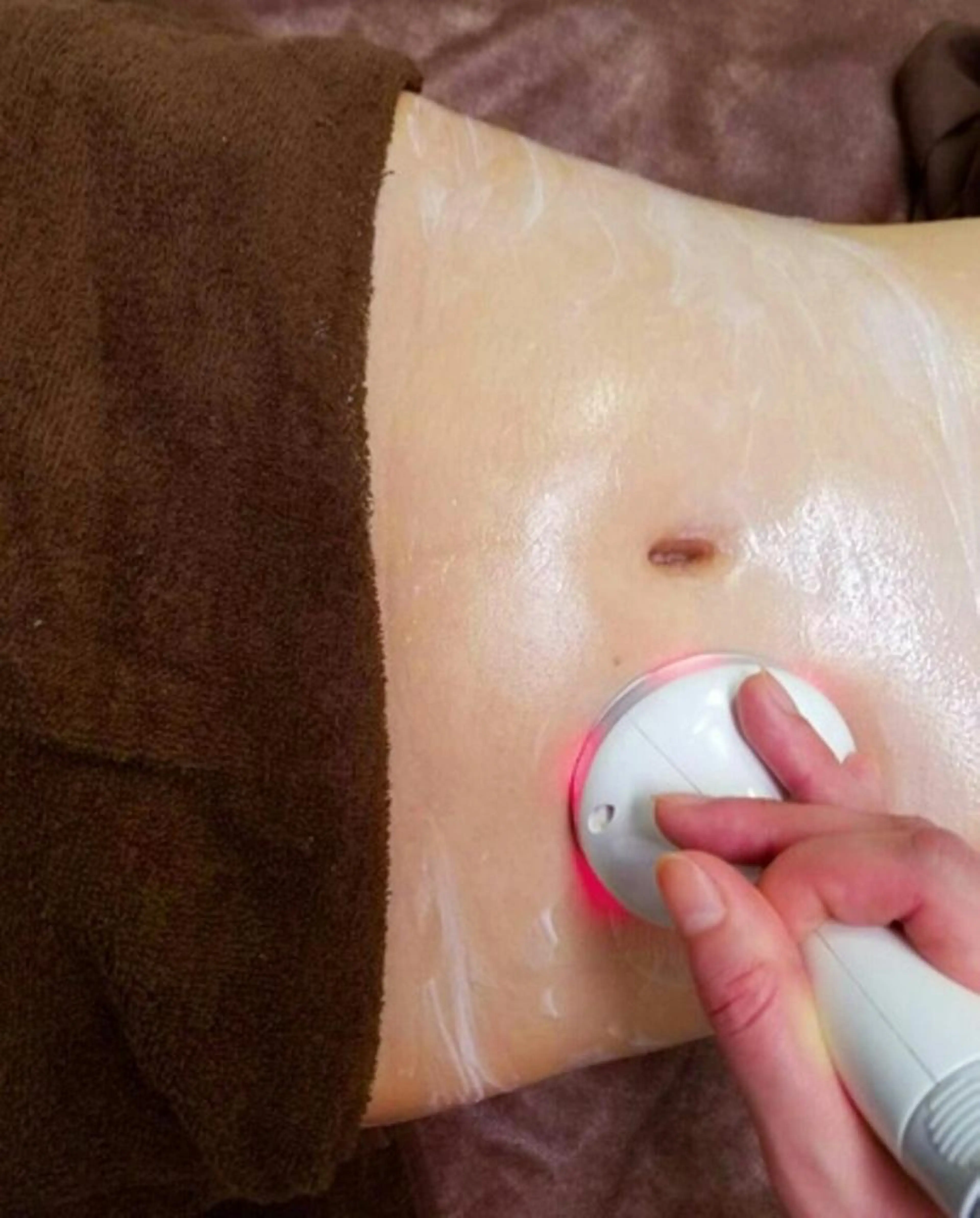 ラジオ派+吸引+LED♥1部分ﾁｮｲｽ痩身の写真