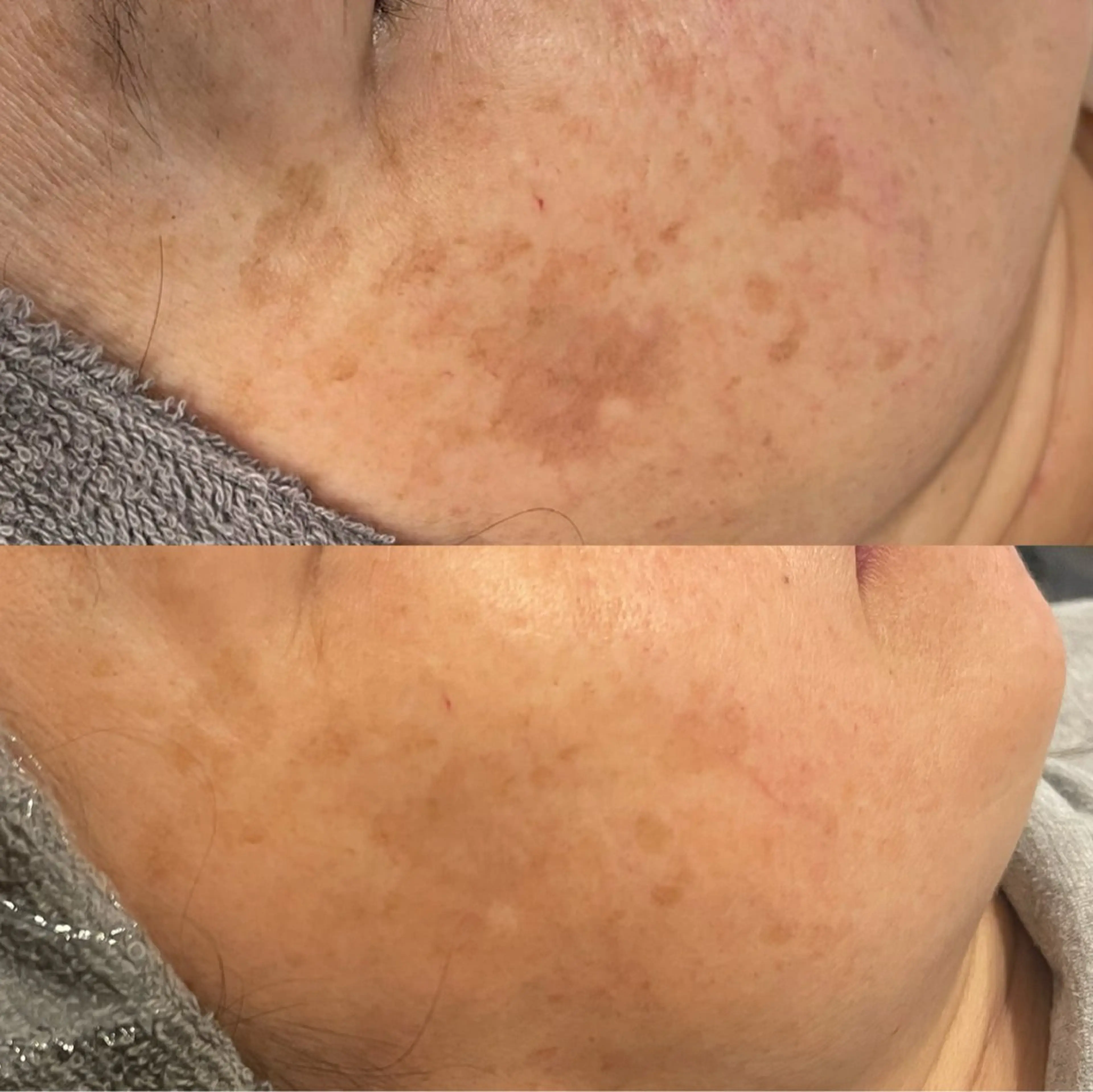 シミケア放題30分➕ラジオ派の写真