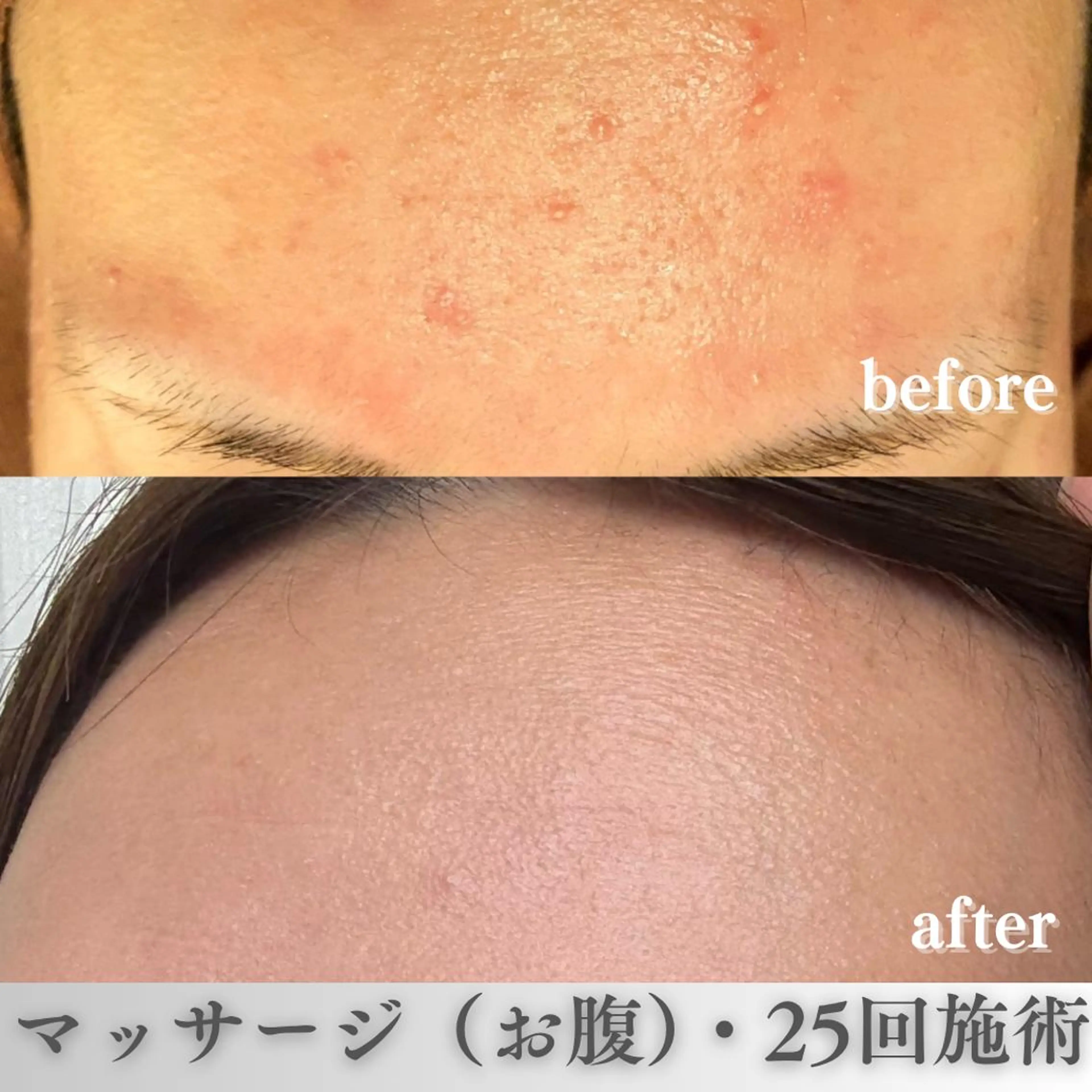 学生ニキビ改善🍀 優しい肌質改善のエステ・リラクイメージ