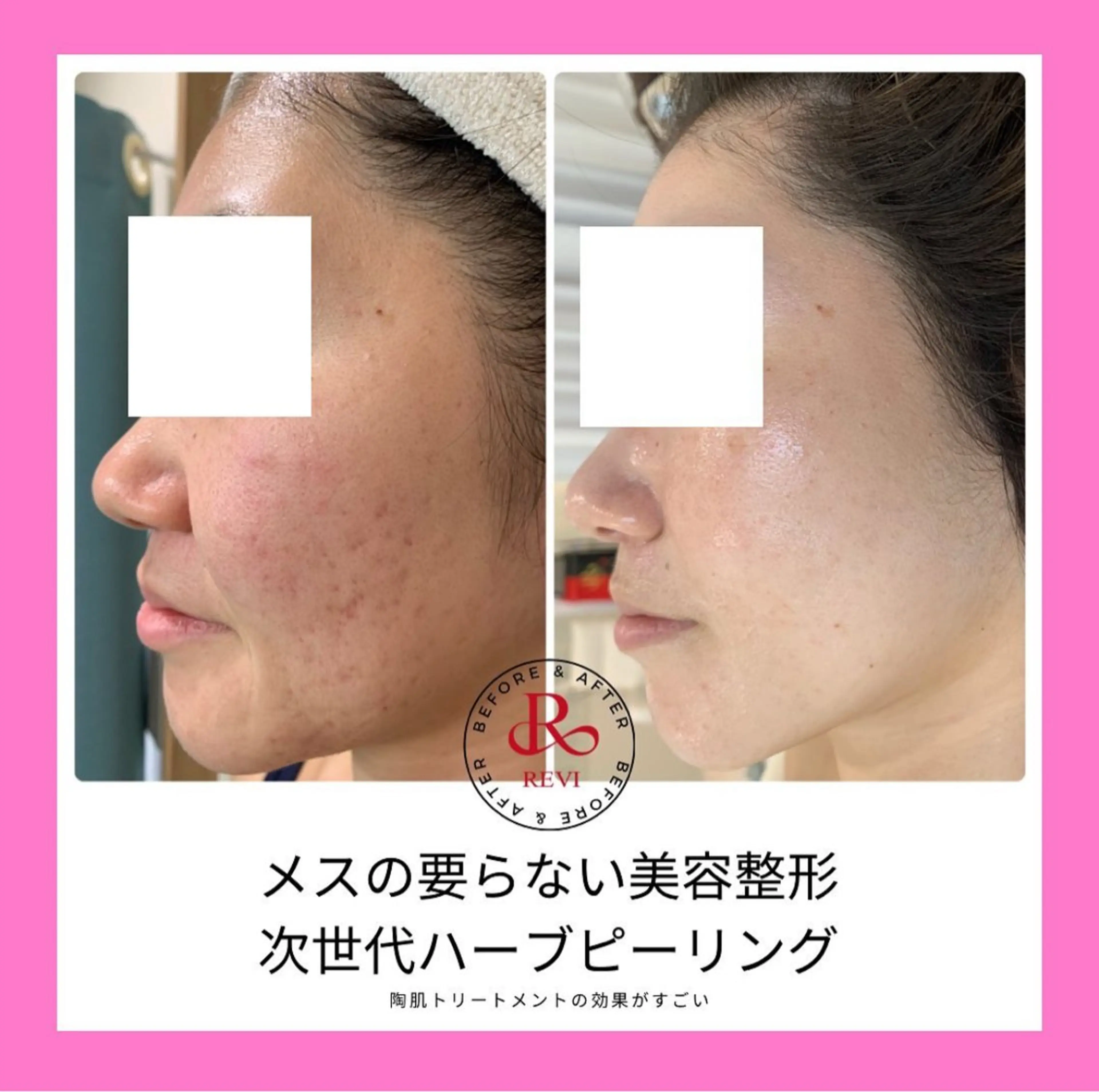 エステ 髪/まつげ/眉/毛穴 ハーブ/他/AIKOのその他イメージ