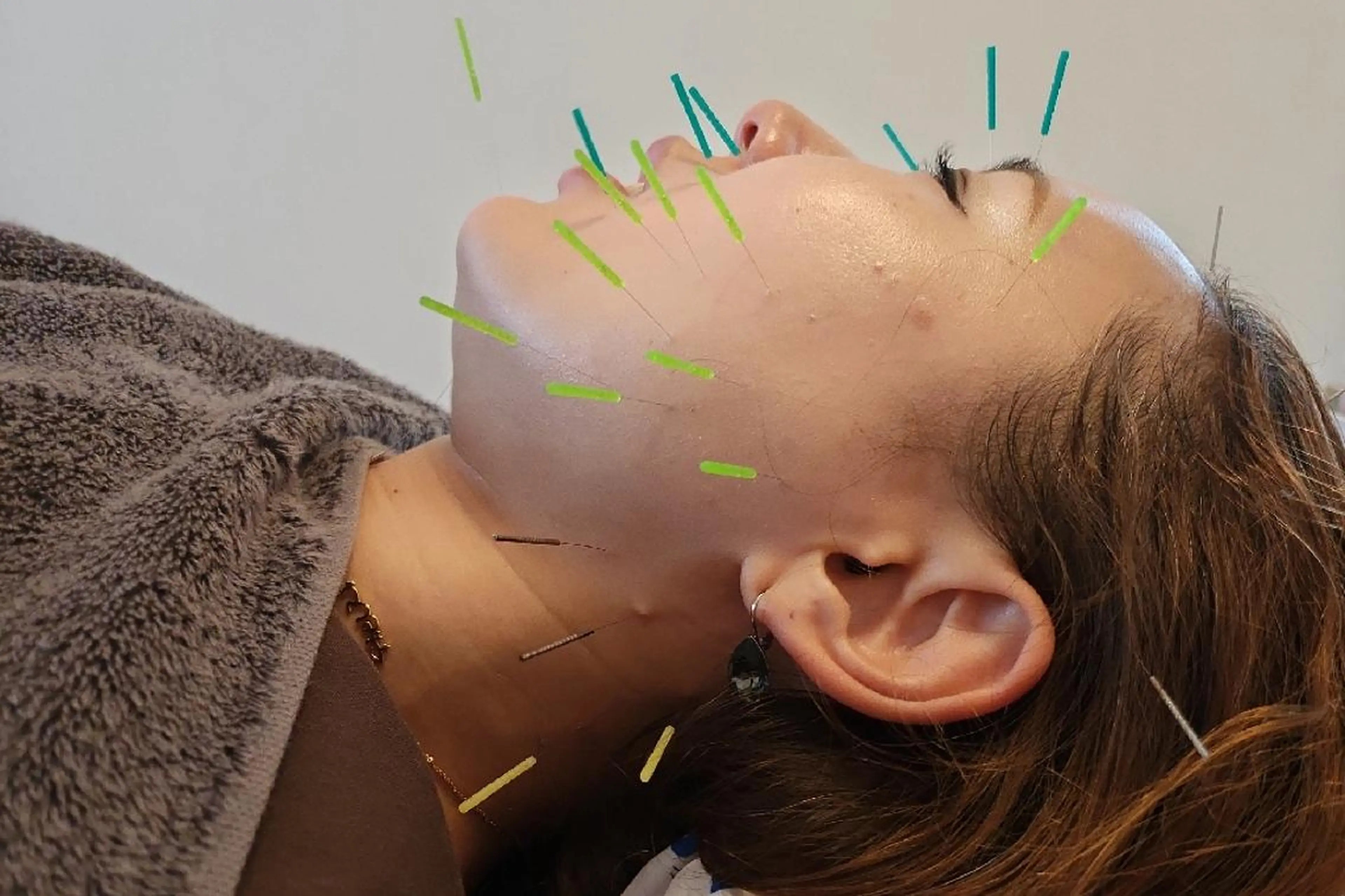 即効⚡小顔美容鍼🪡 むくみたるみ脂肪解消のエステ・リラクイメージ