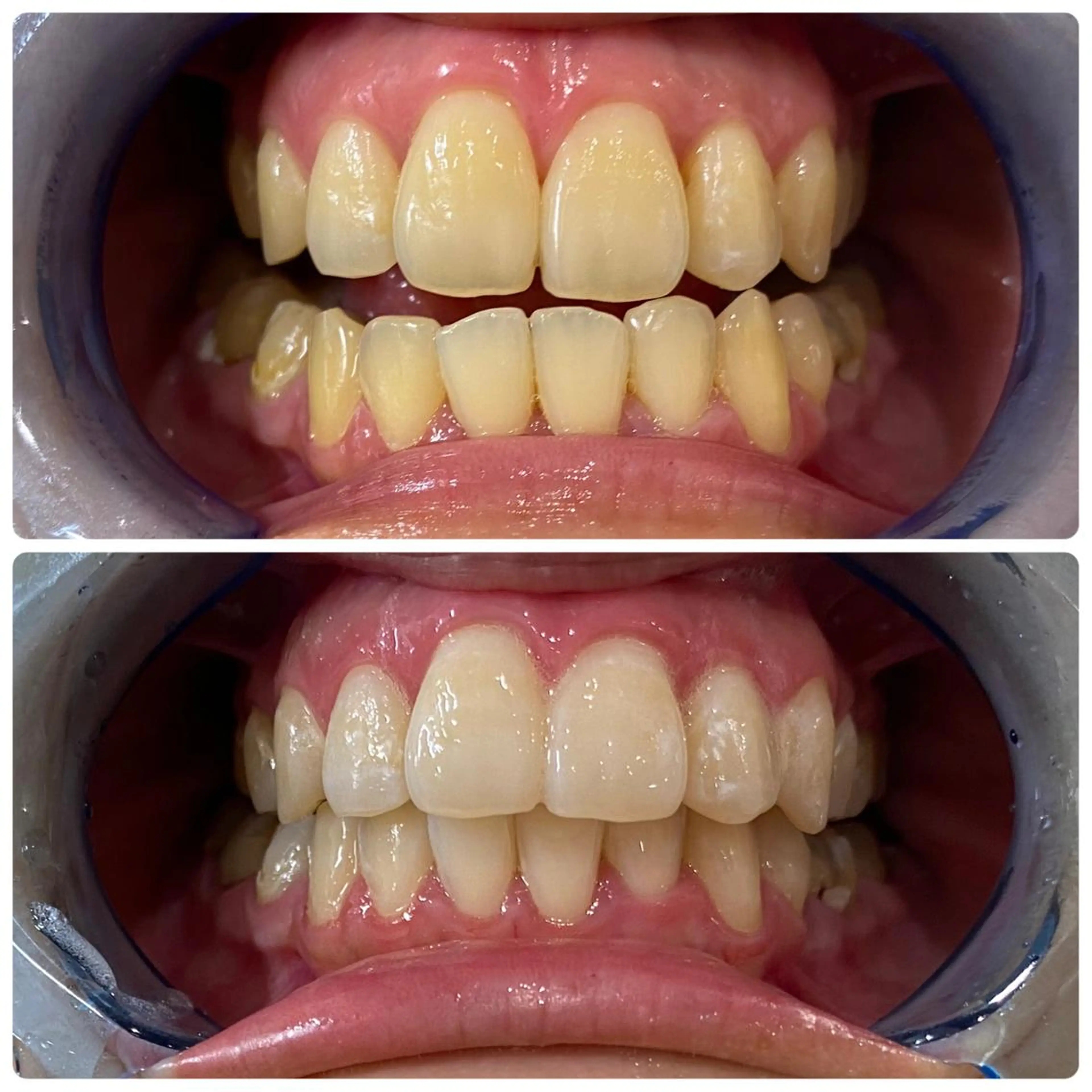 その他 White Berry SELF BEAUTY SALON所属・セルフホワイトニング 🦷口元垢抜け✨のその他イメージ