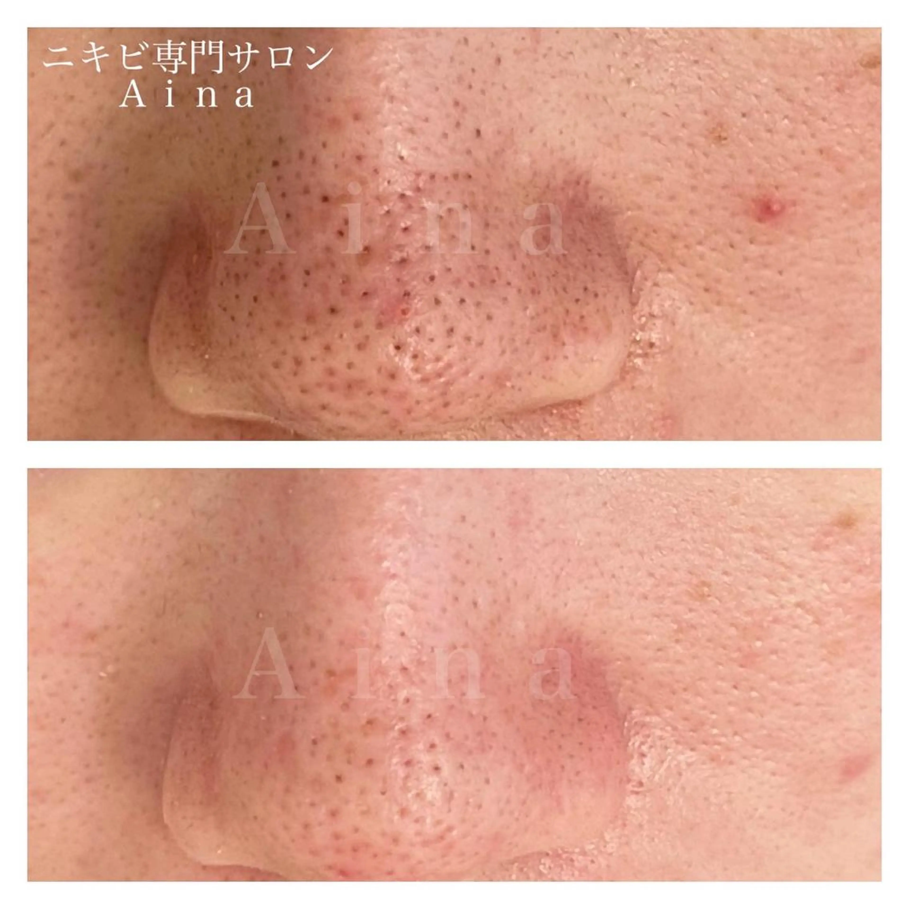 セミロング パーマ ヘアアレンジ メンズ キッズ ネイル マツエク・マツパ アイブロウ エステ リラク ニキビ跡専門サロン Ａｉｎａのエステ・リラクイメージ