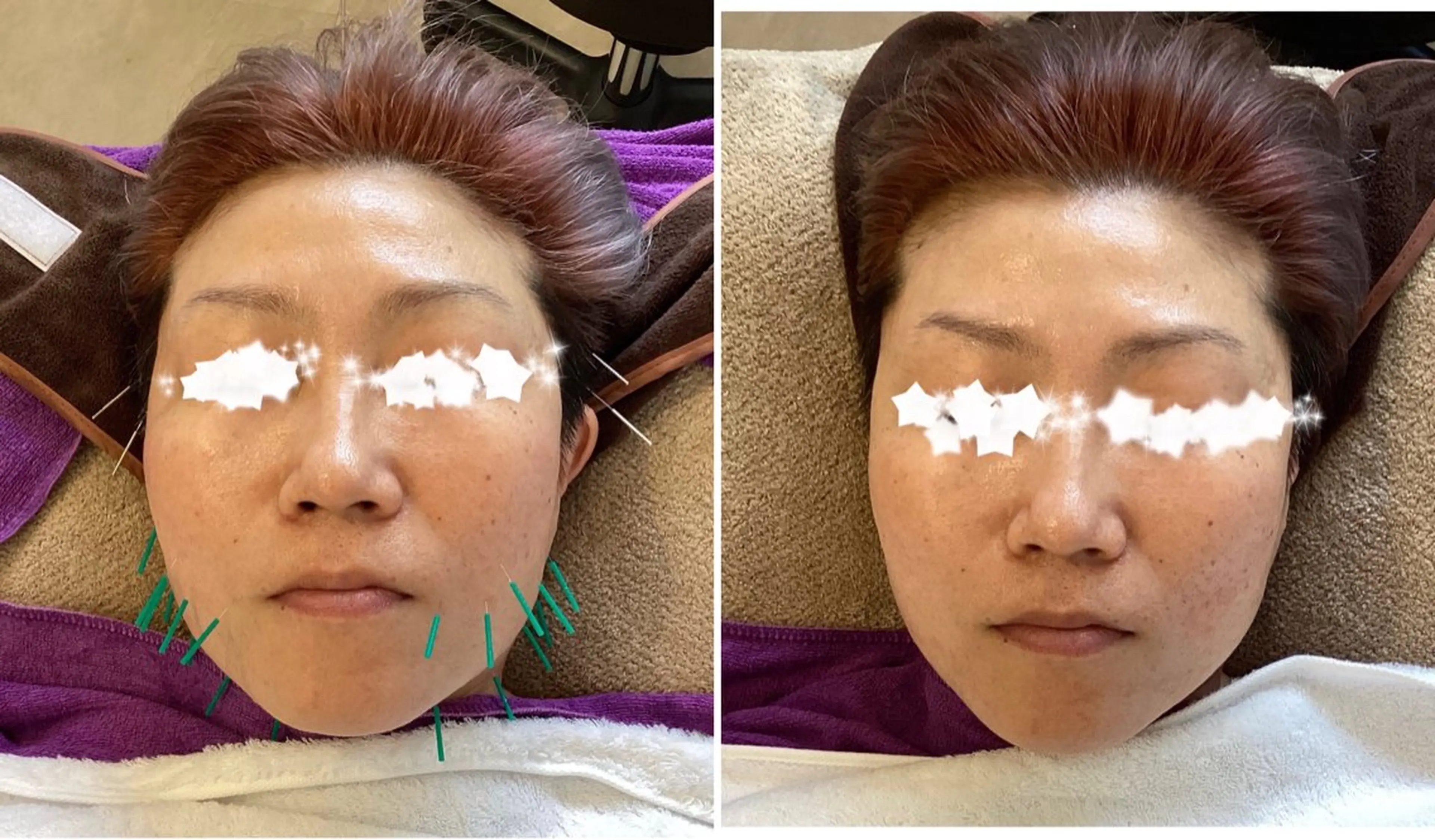 👛モニター価格👛回数券　大好評‼︎美容鍼20本　6回施術分　通常価格6600円【1回3300円美容鍼のみ】2ヶ月間の写真