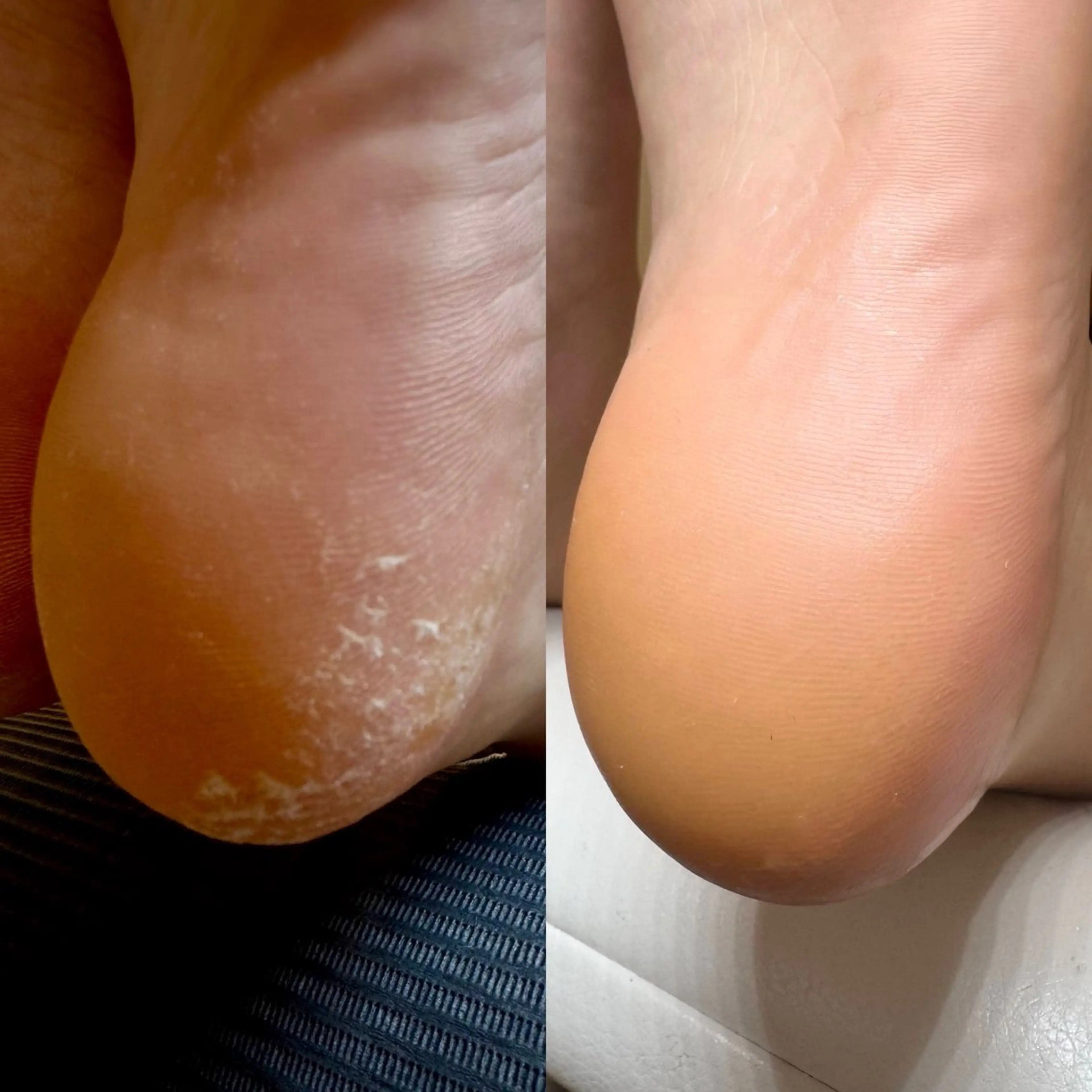 ＼夏のフットケア🌻.*／ツルツルかかとへ～👣✨️の写真