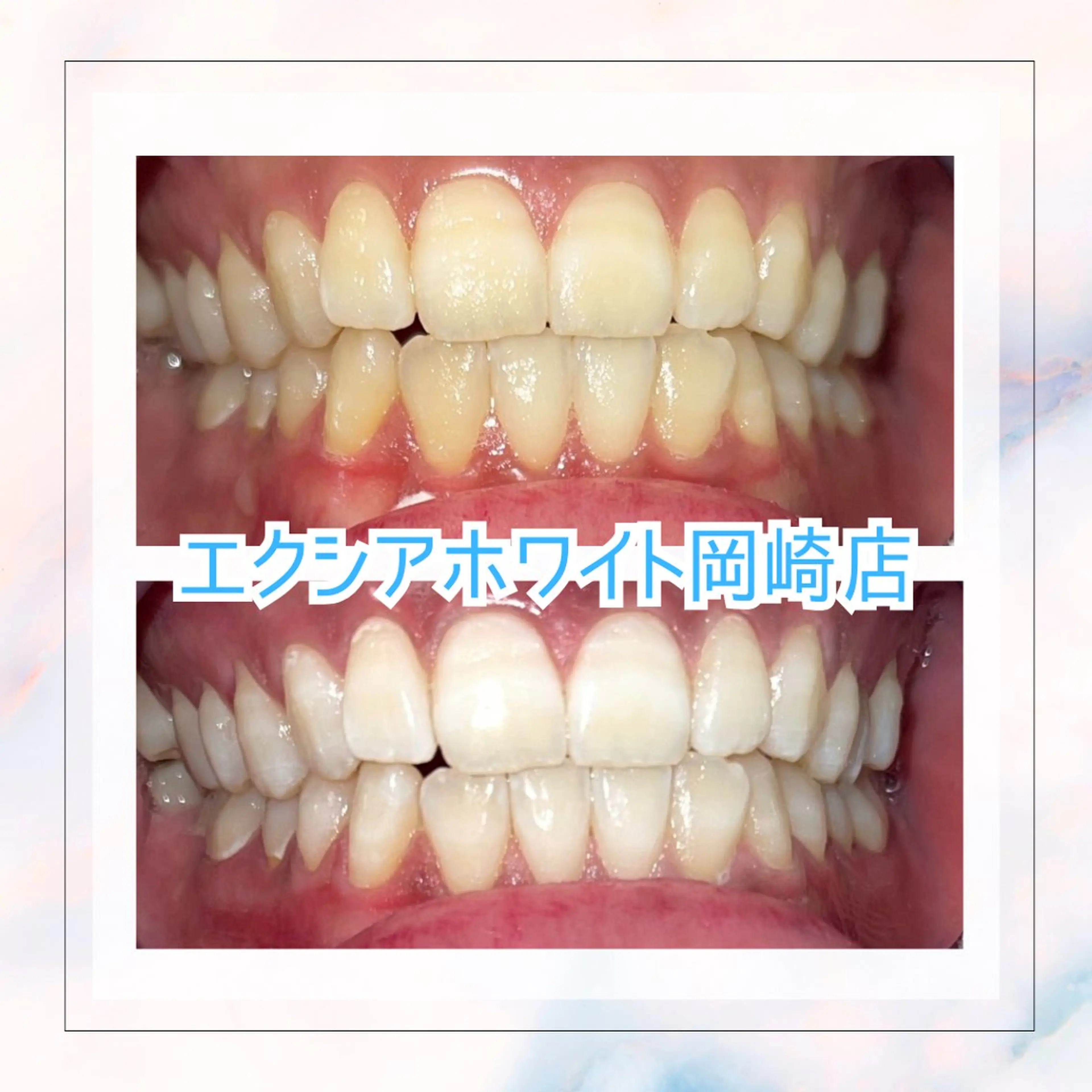 【白レベル★★】セルフホワイトニング2照射30分 初回クーポン✨️【ミニモ限定初回50%オフ✨️】の写真