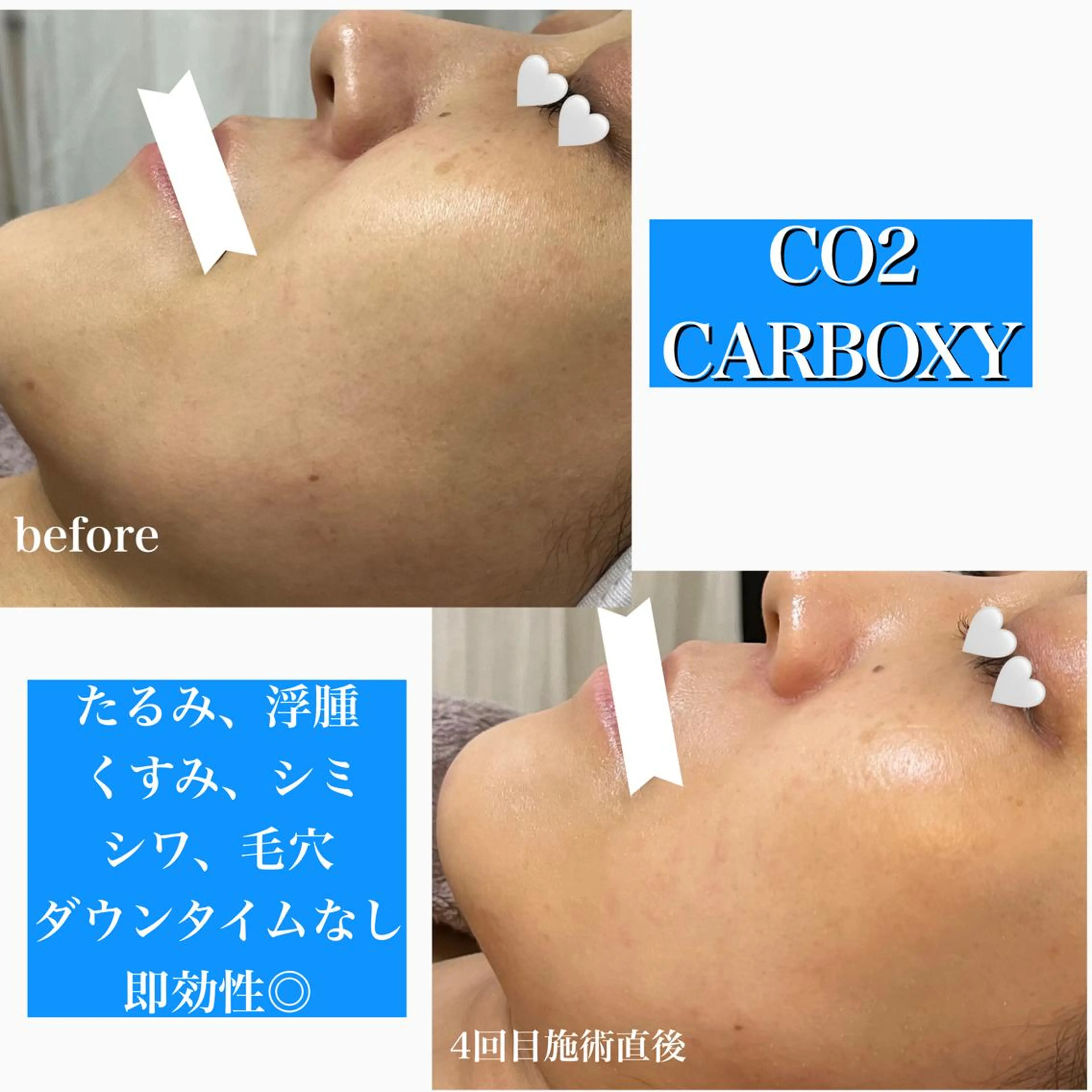 1ヶ月後も半分残る 高持続LEDエクステのマツエク・マツパデザイン