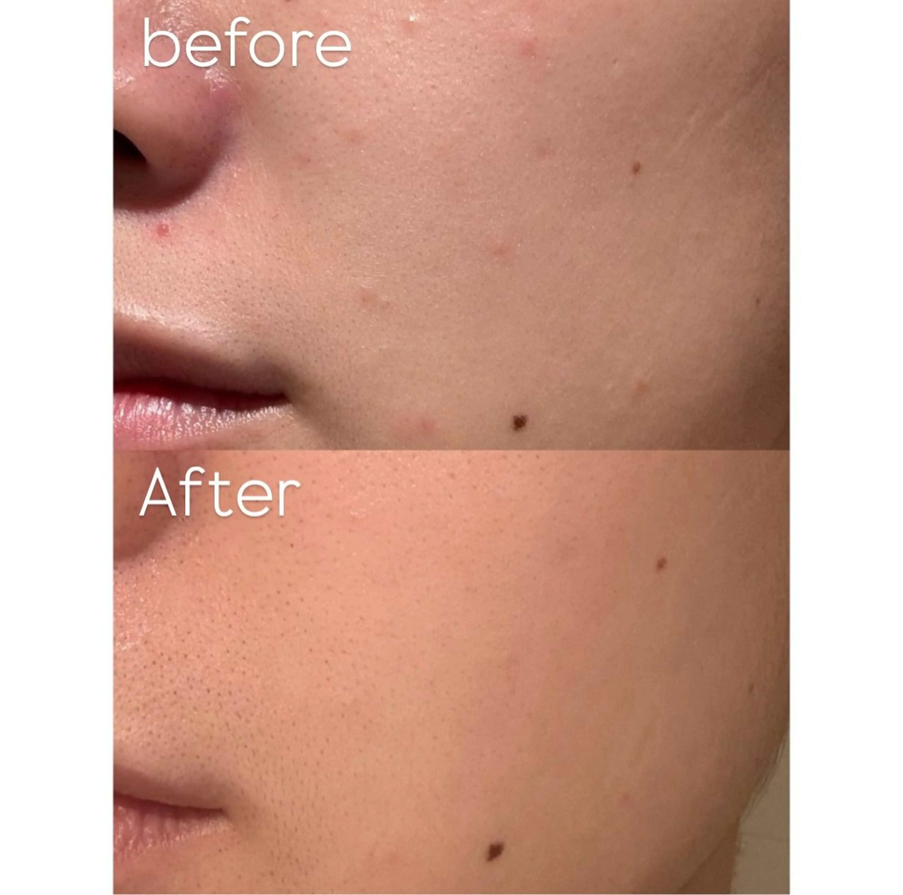 エステ リラク himee所属・艶肌ハーブピーリング /毛穴洗浄のエステ・リラクイメージ