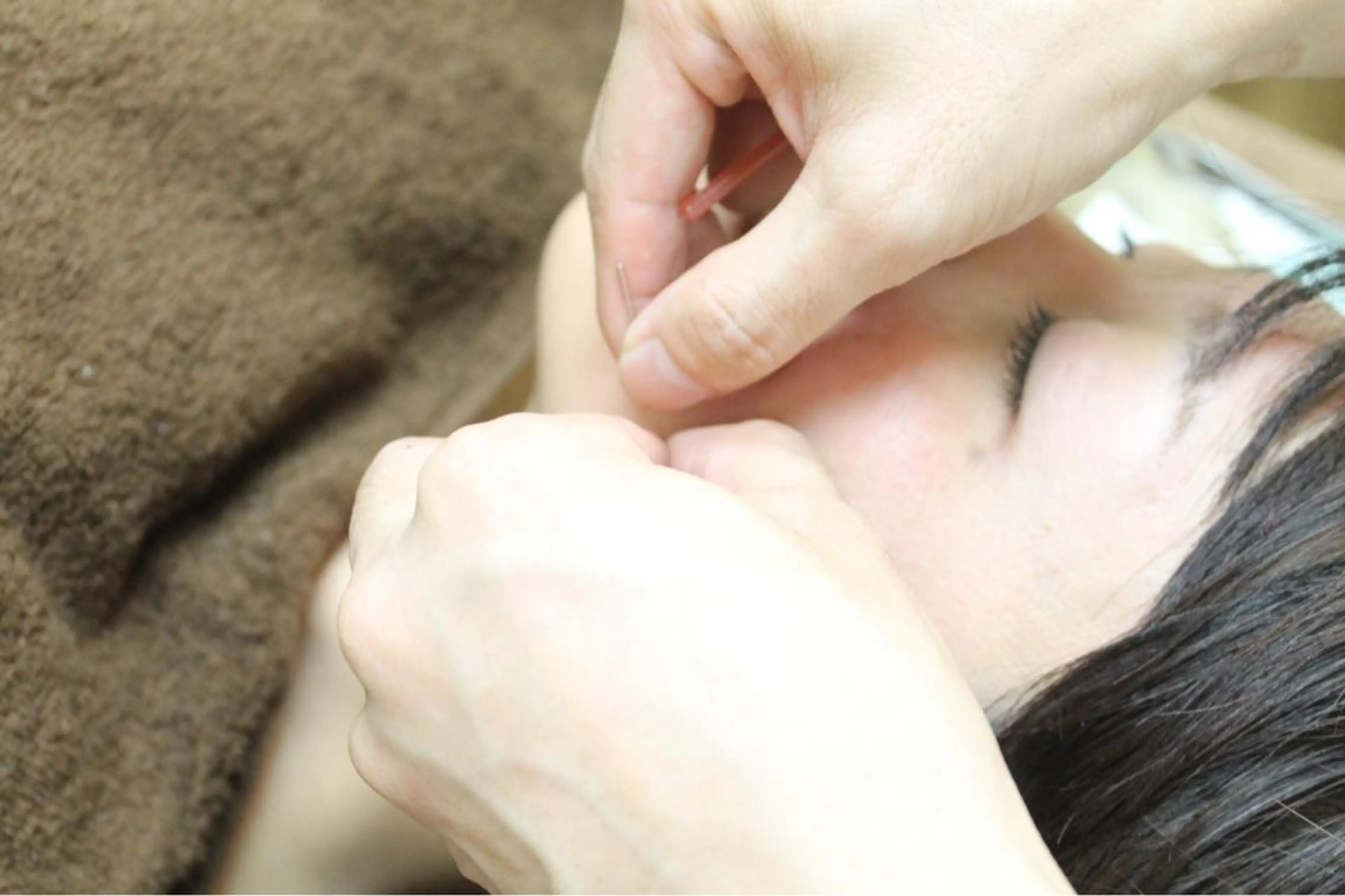 20代まで限定✨お顔スッキリICCO式美容鍼コース❣️ 【ミニモ初回限定】の写真