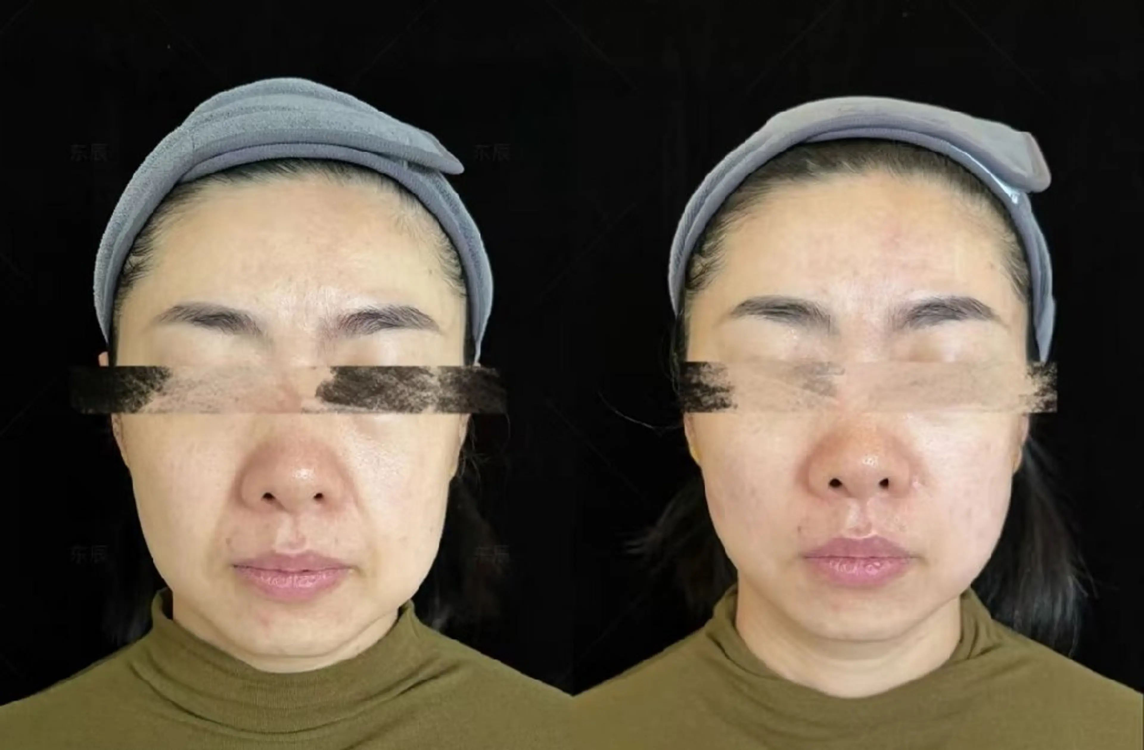 アイブロウ 眉毛ワックス脱毛 aliaハイフ&水光ジェットサロン所属・aliaハーブ水光店 エステティシャン募集のエステ・リラクイメージ