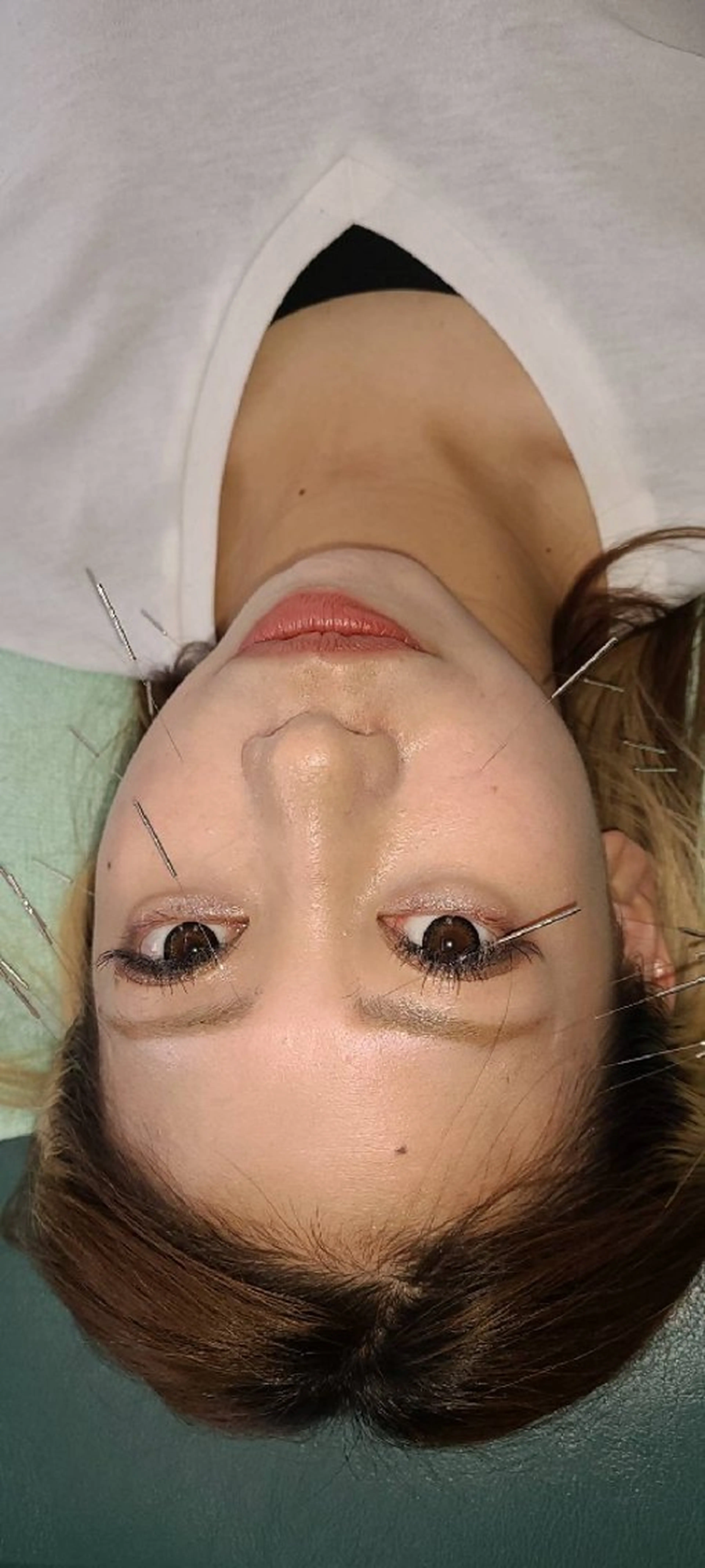 シミ、しわ、むくみはこれで解決！顎もスッキリして笑顔も素敵✨　　　　　　　⦿美顔鍼の写真