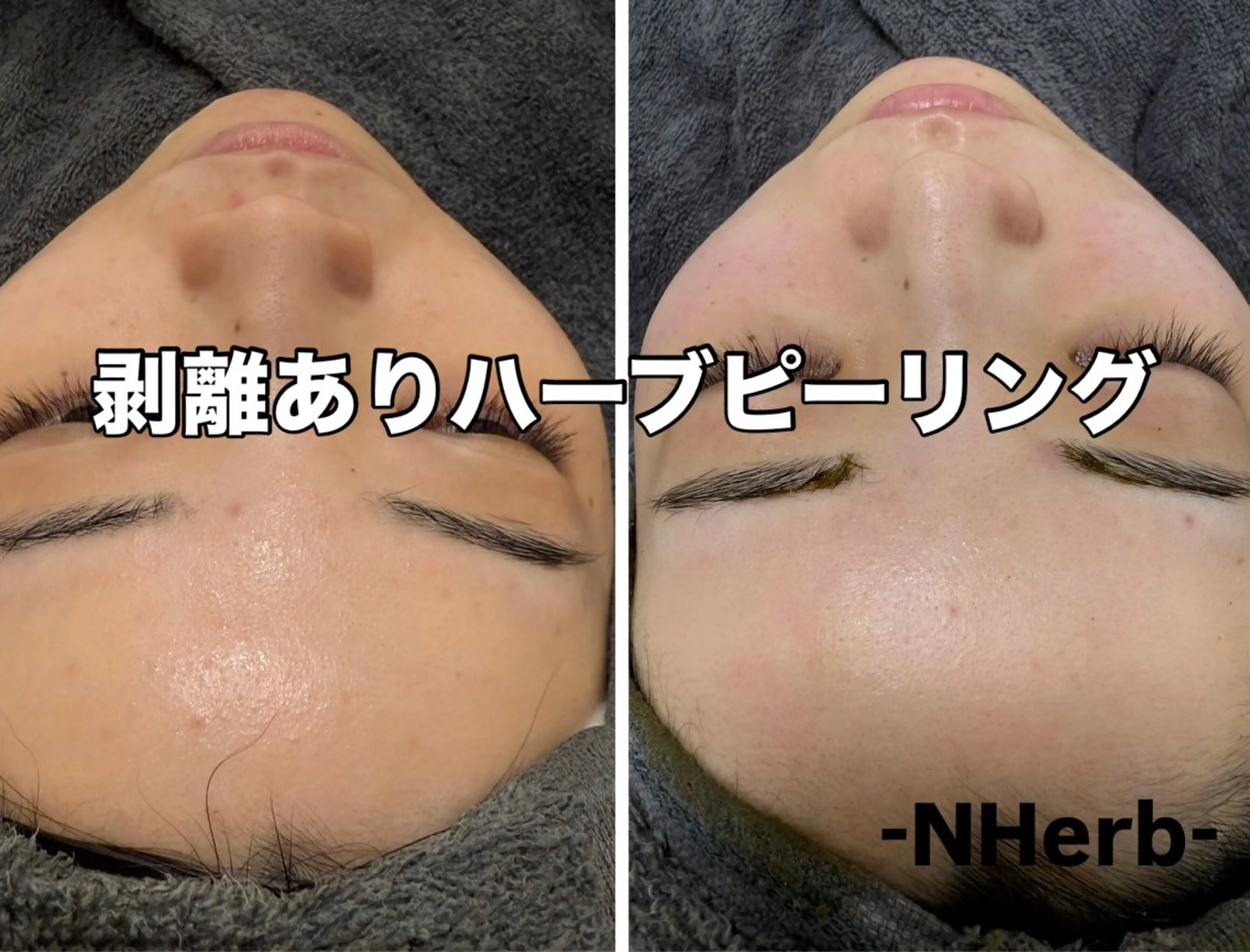 【剥けるハーブピーリング】ダウンタイムありますの写真