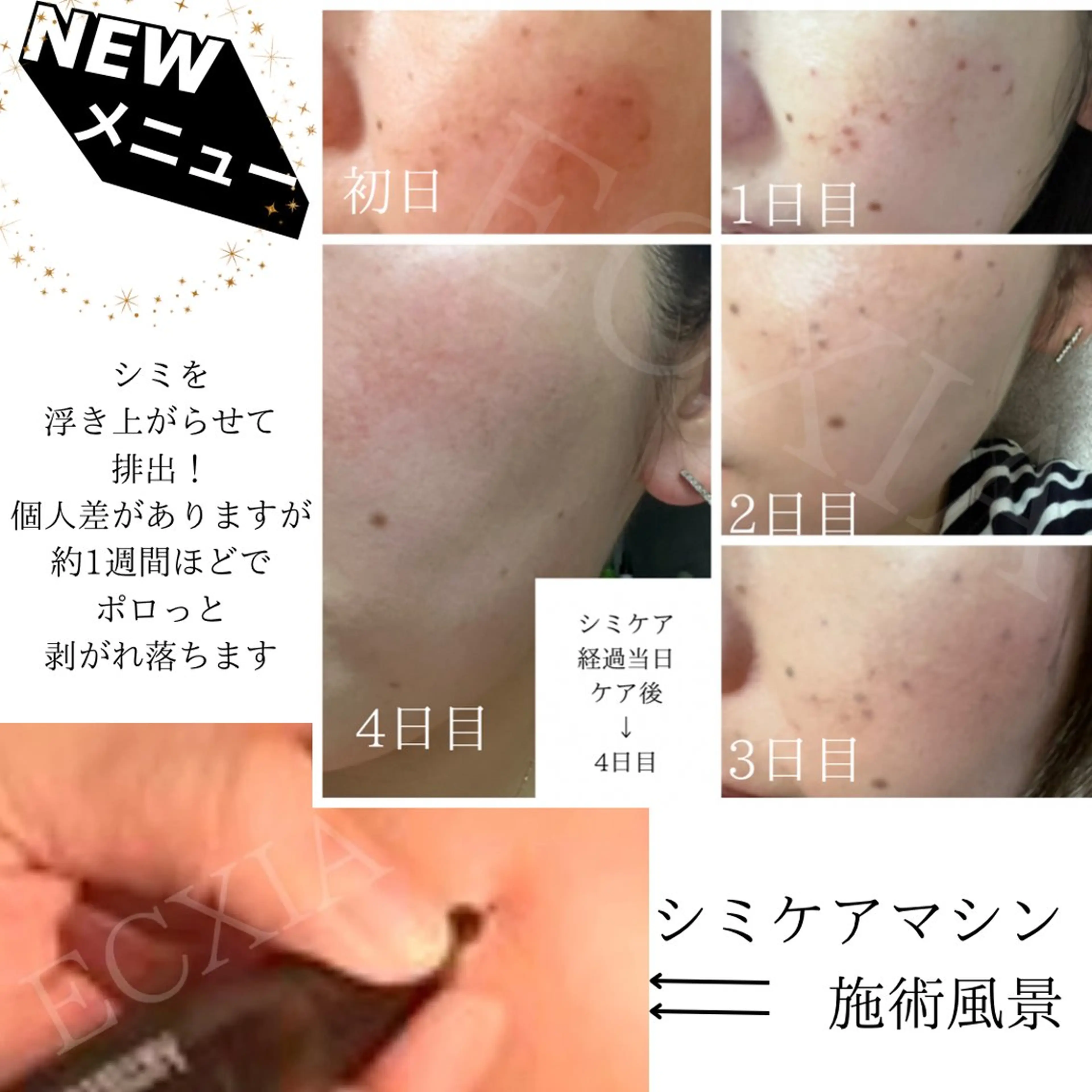 【シミケアメニュー】スタンダードケア　クレンジング→シミケア→肌別パック　《10分打ち放題》の写真