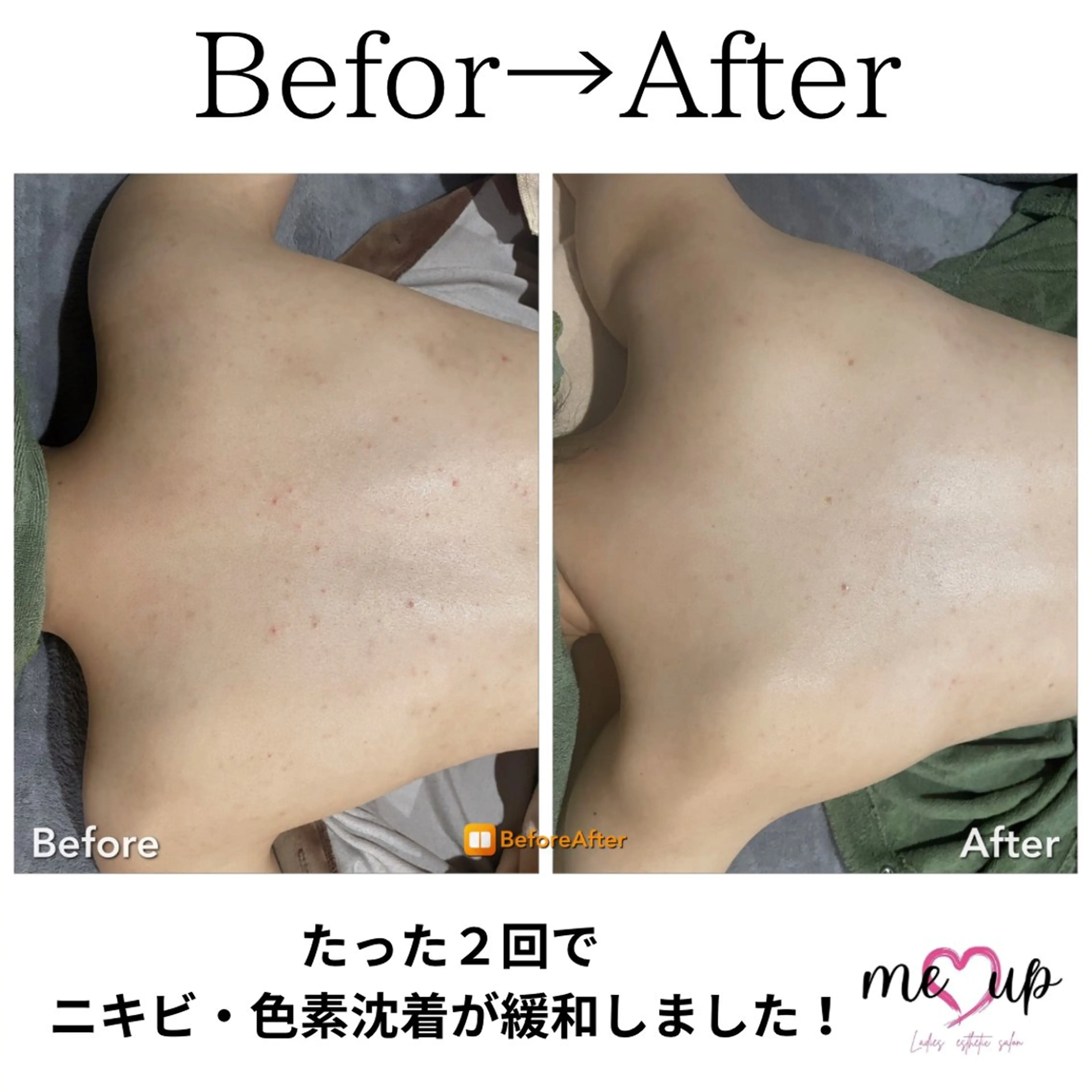 エステ Meupニキビ専門店 背中/ハーブ/肌管理のその他イメージ