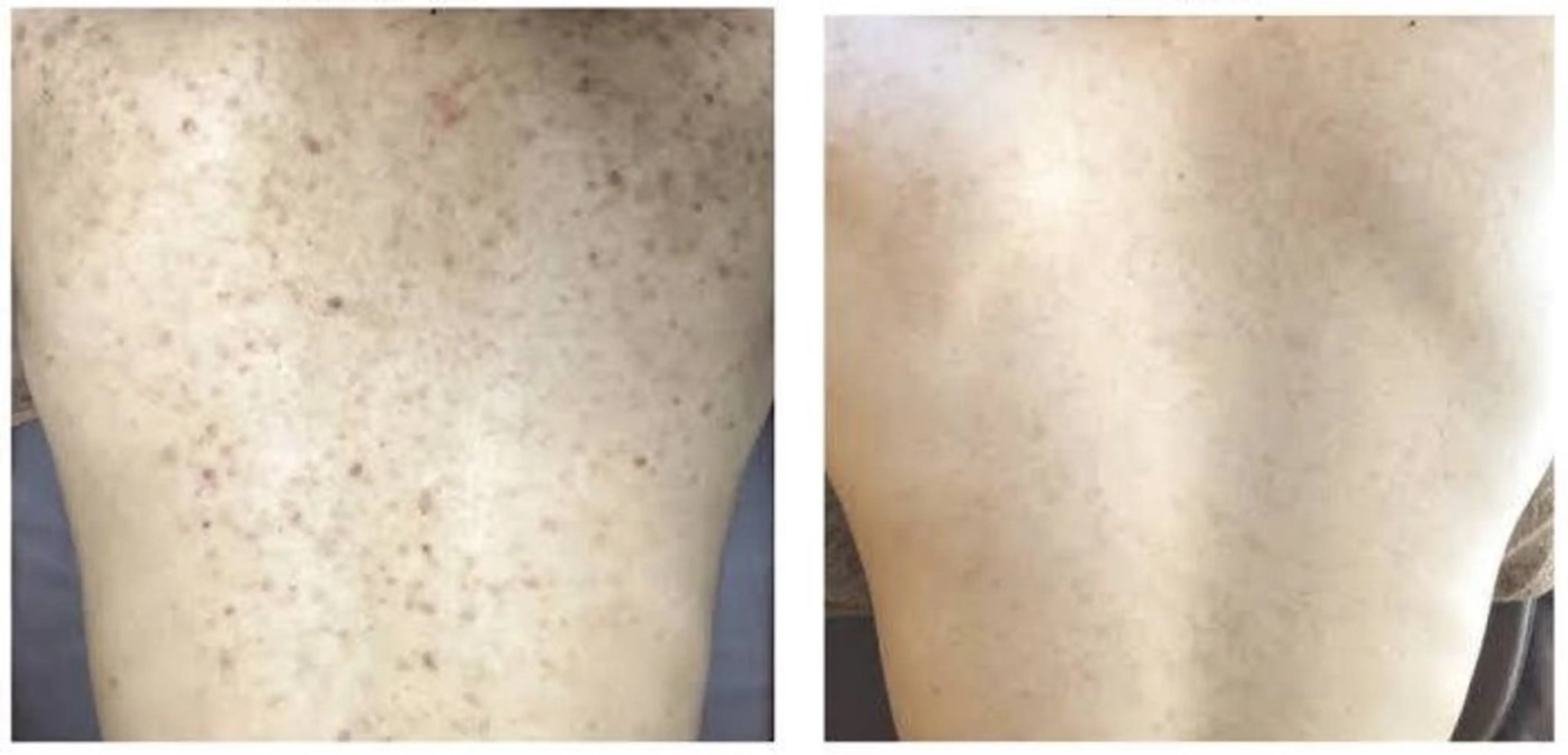 背中ハーブピーリング⭐️ニキビ/肌荒れの写真