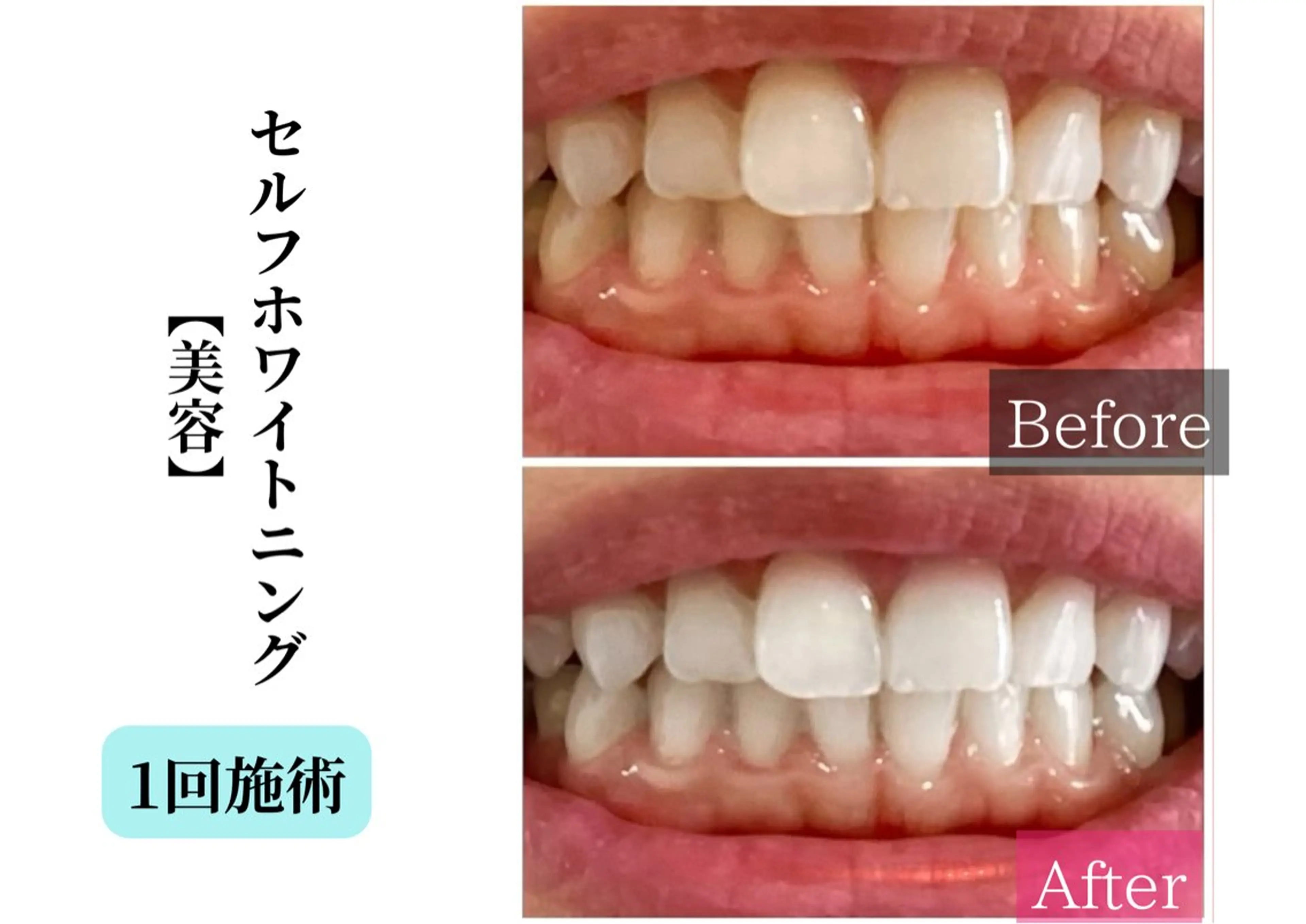 【ピュアホワイトニング】白い歯で自信溢れる笑顔に♪お子様にも◎ 《初回限定💫特別価格》の写真