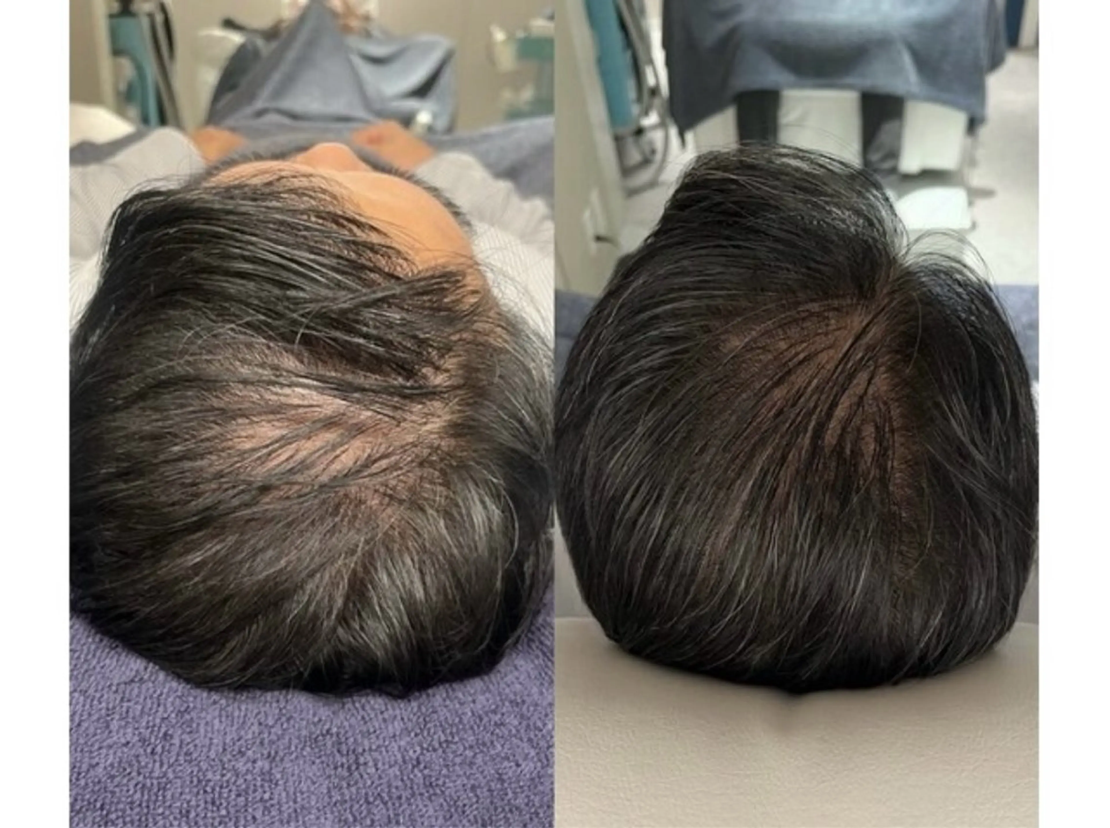 【育毛促進☆白髪×頭皮ケア】毛根再生幹細胞トリートメント💆‍♂️✨の写真