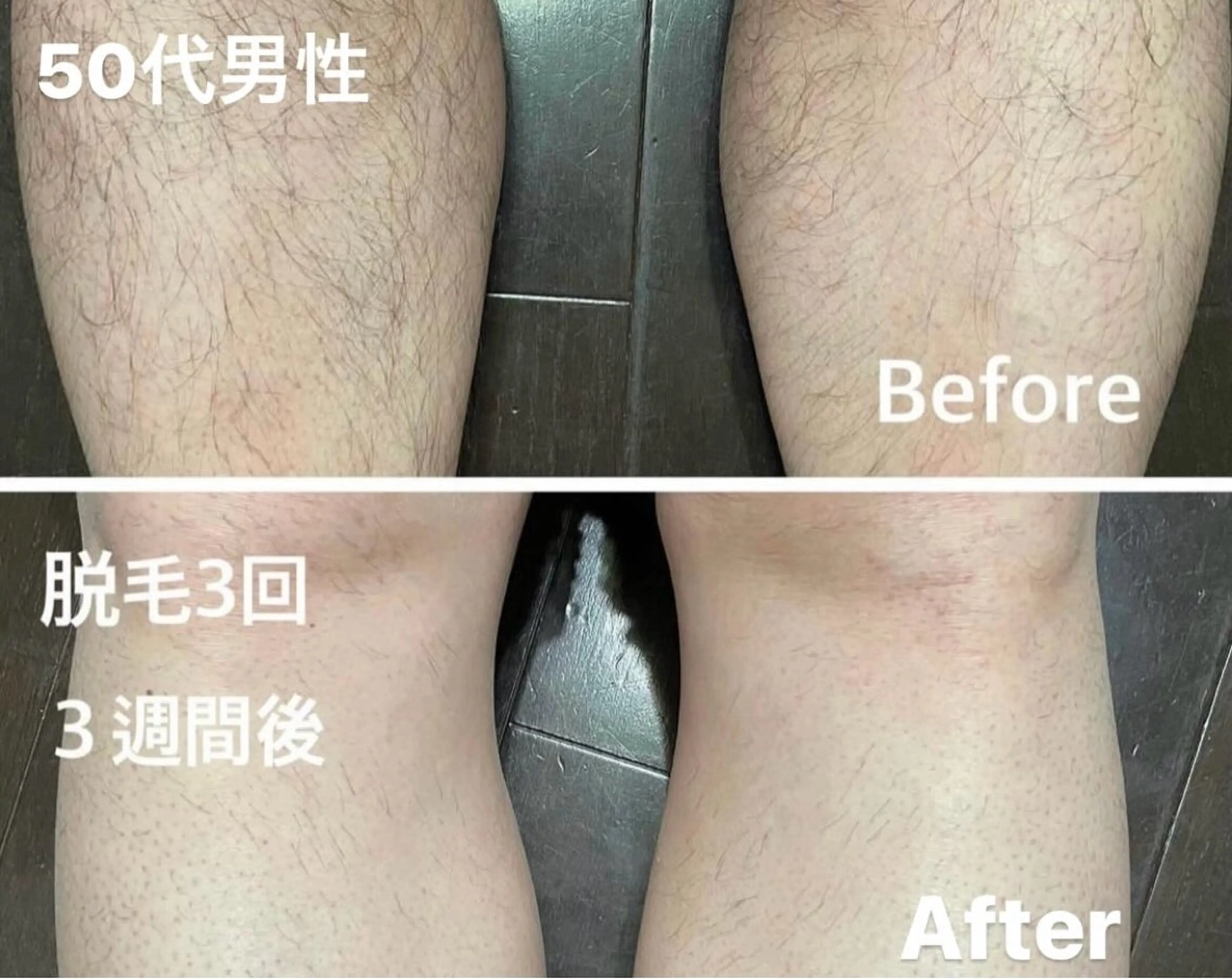 メンズ 🌿ハーブピーリング ・脱毛◆Refreのエステ・リラクイメージ