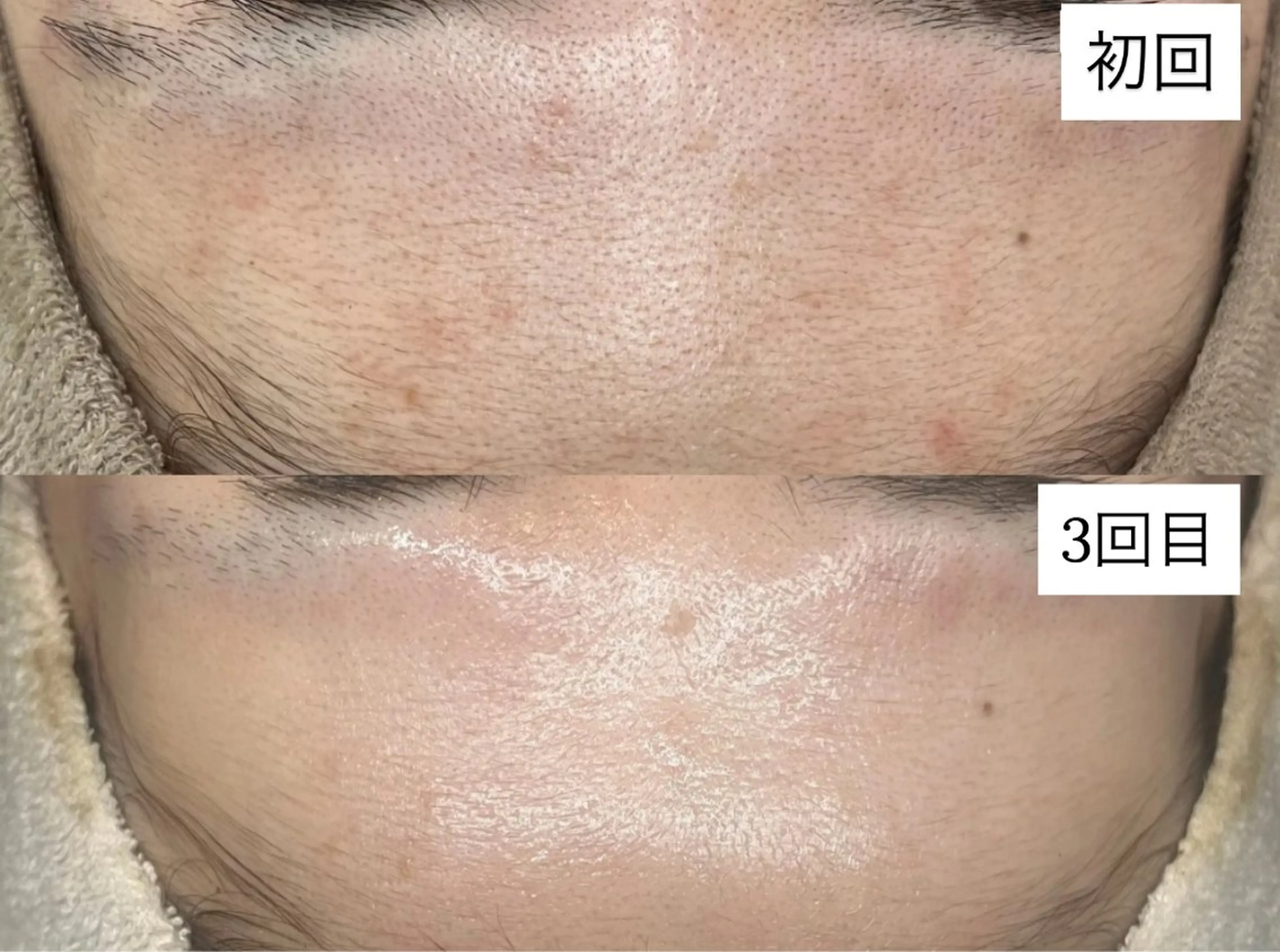 エステ BELLIS HUIT所属・ハーブピーリング那覇 BELLISHUITのエステ・リラクイメージ