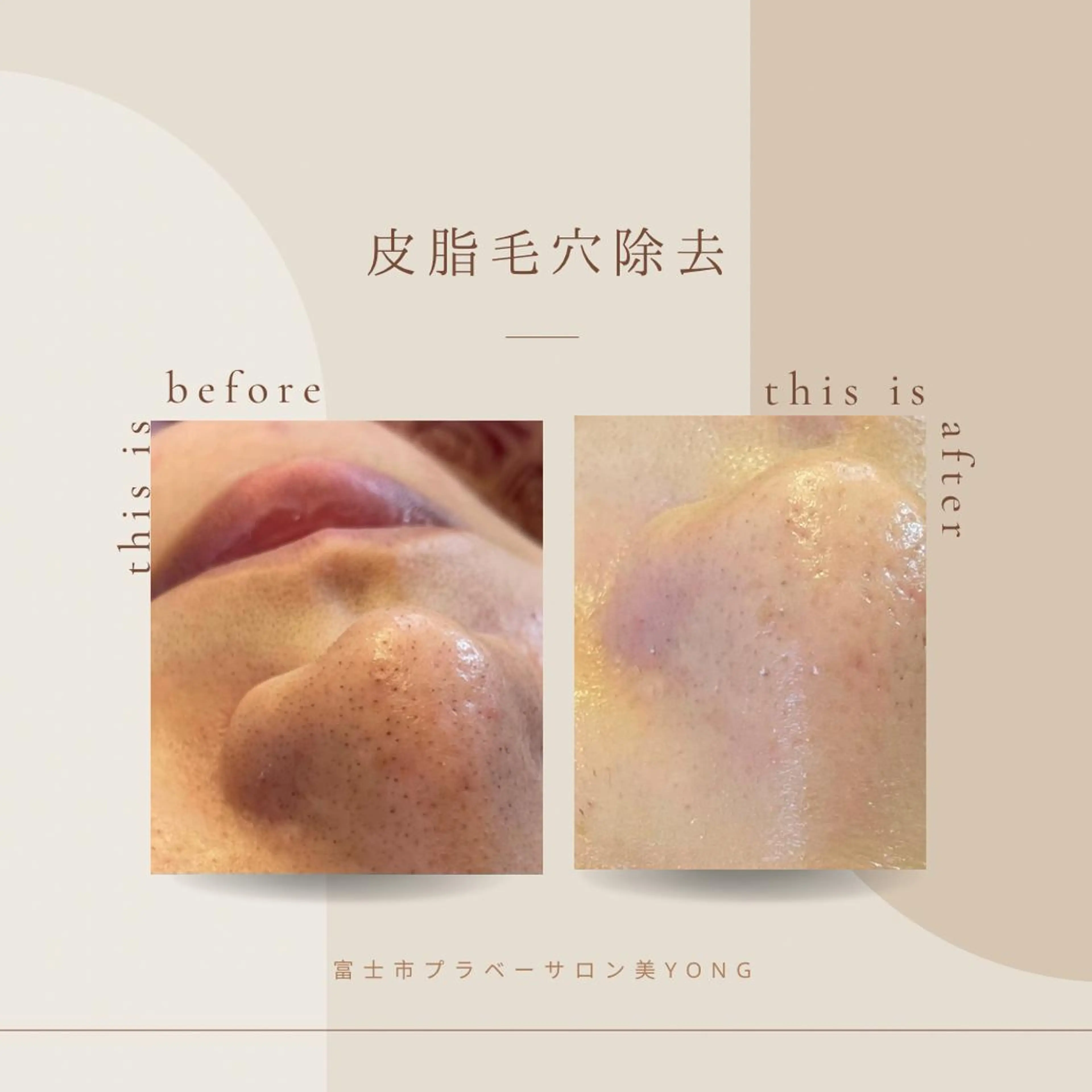 フェイシャル皮脂毛穴洗浄の写真