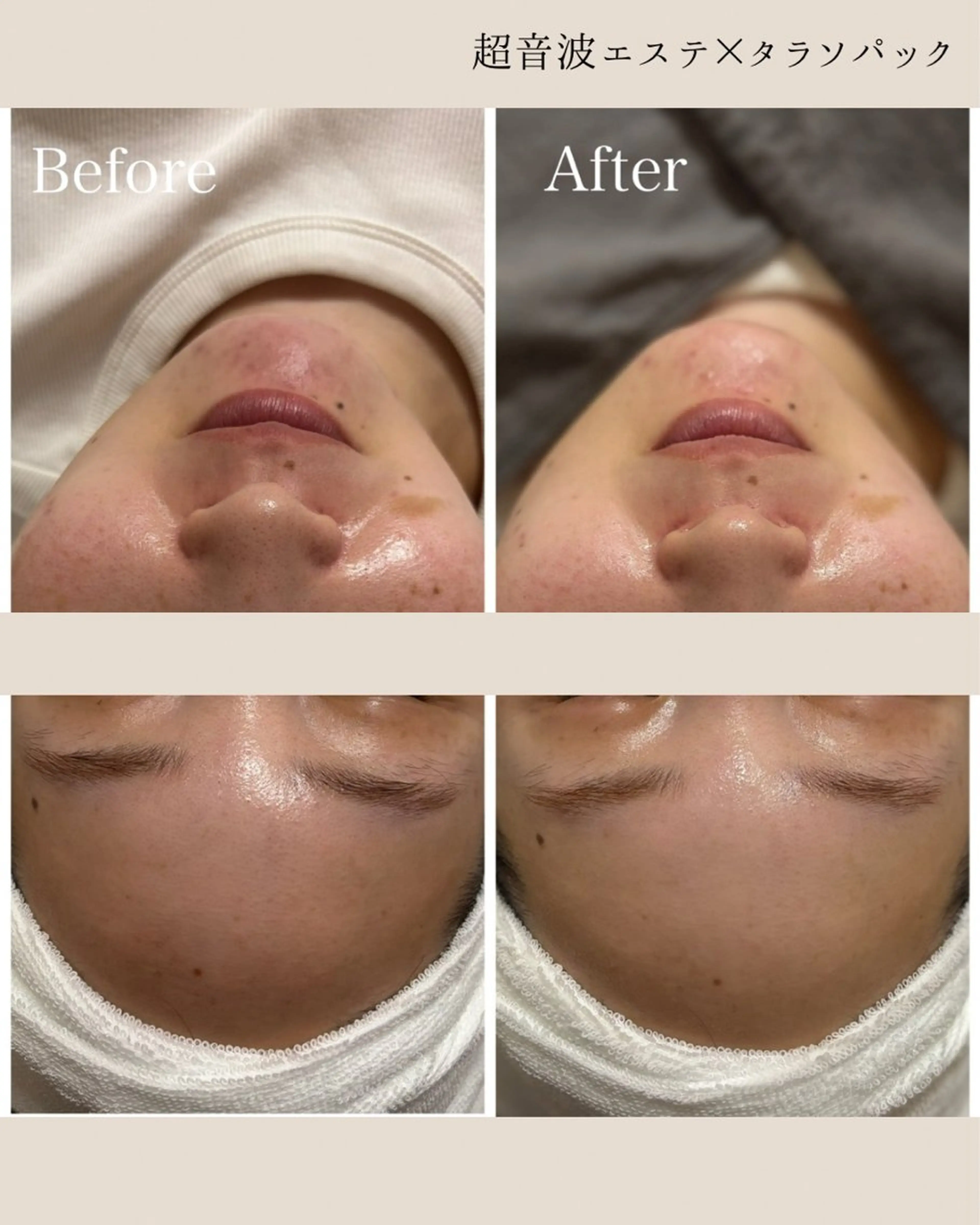 エステ 姫路/肌質改善 /やまもとのエステ・リラクイメージ