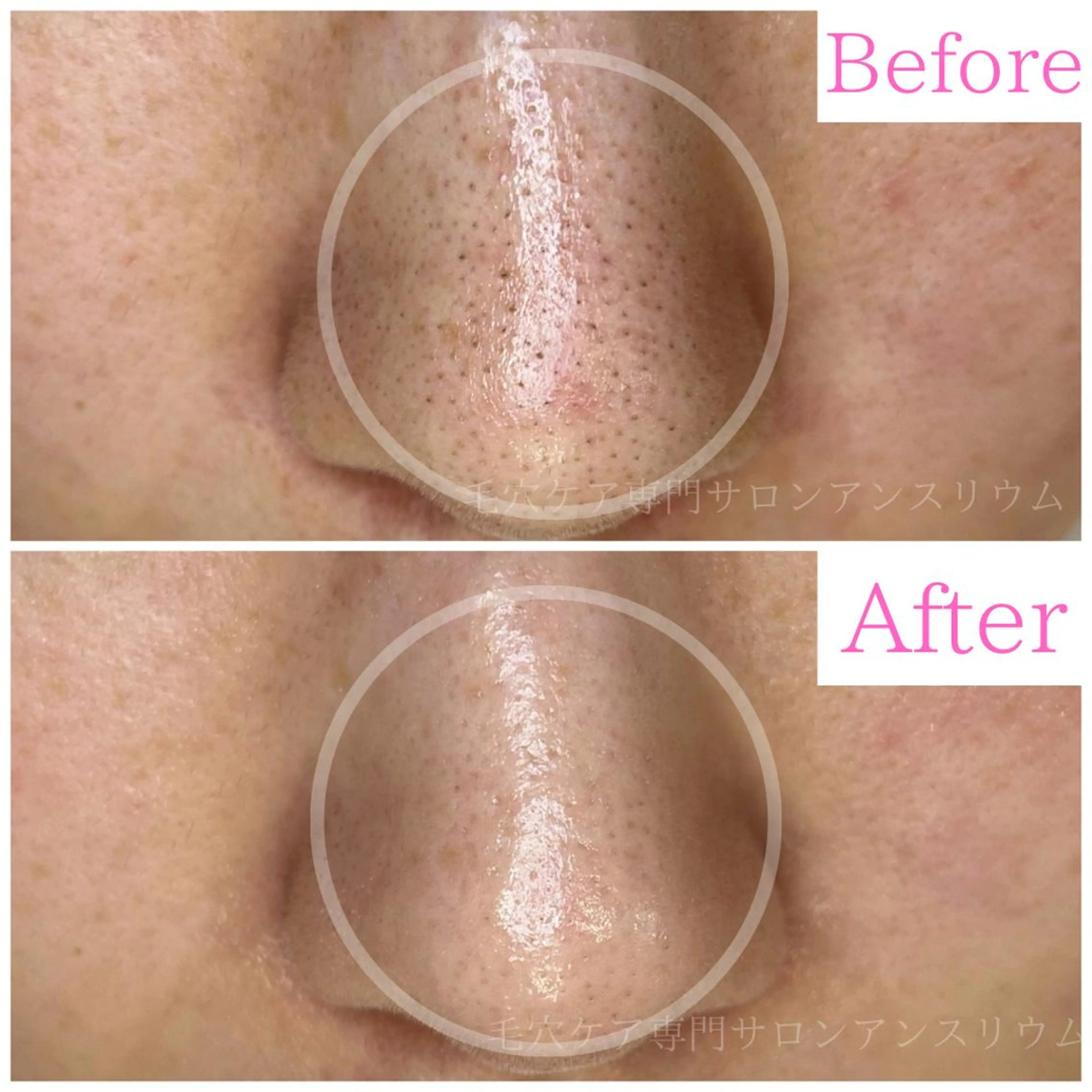 毛穴ケア専門サロンアンスリウム所属・茨城土浦 つくば毛穴 ケア専門サロンのエステ・リラクイメージ